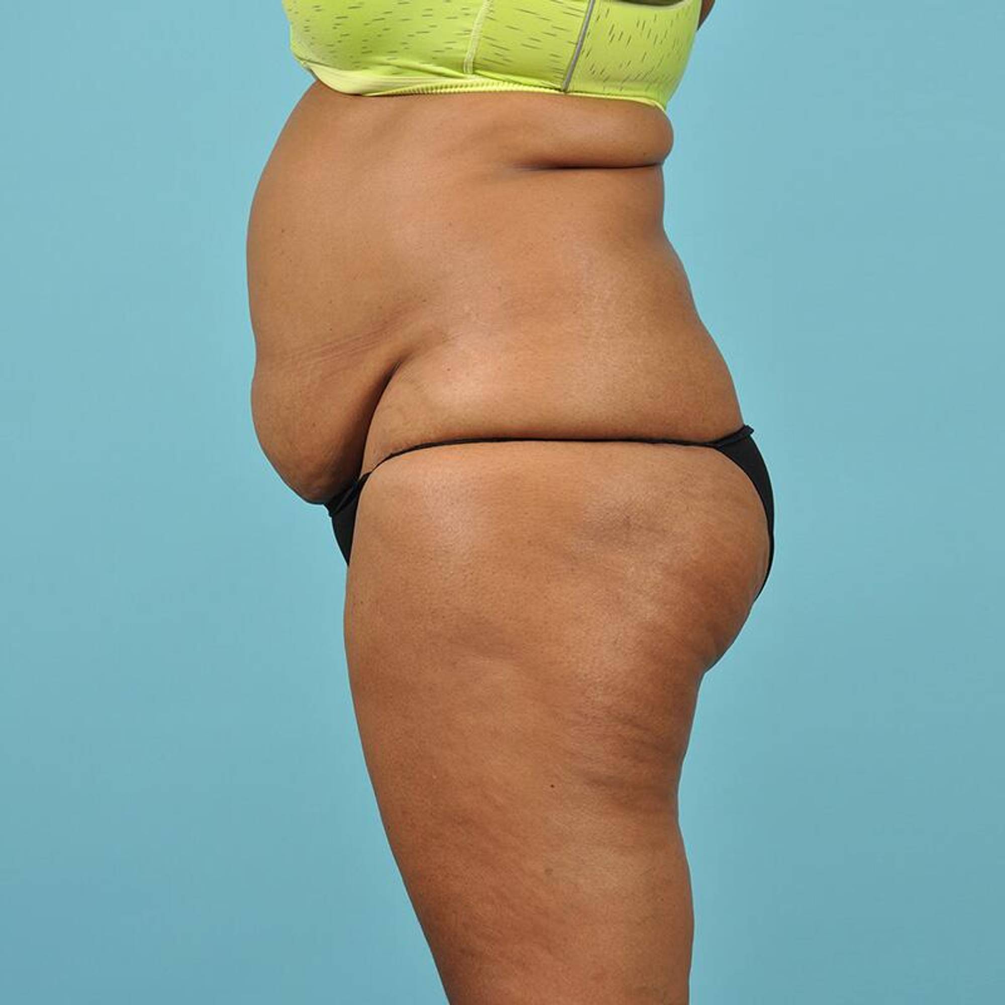 Liposuction Before & After Image