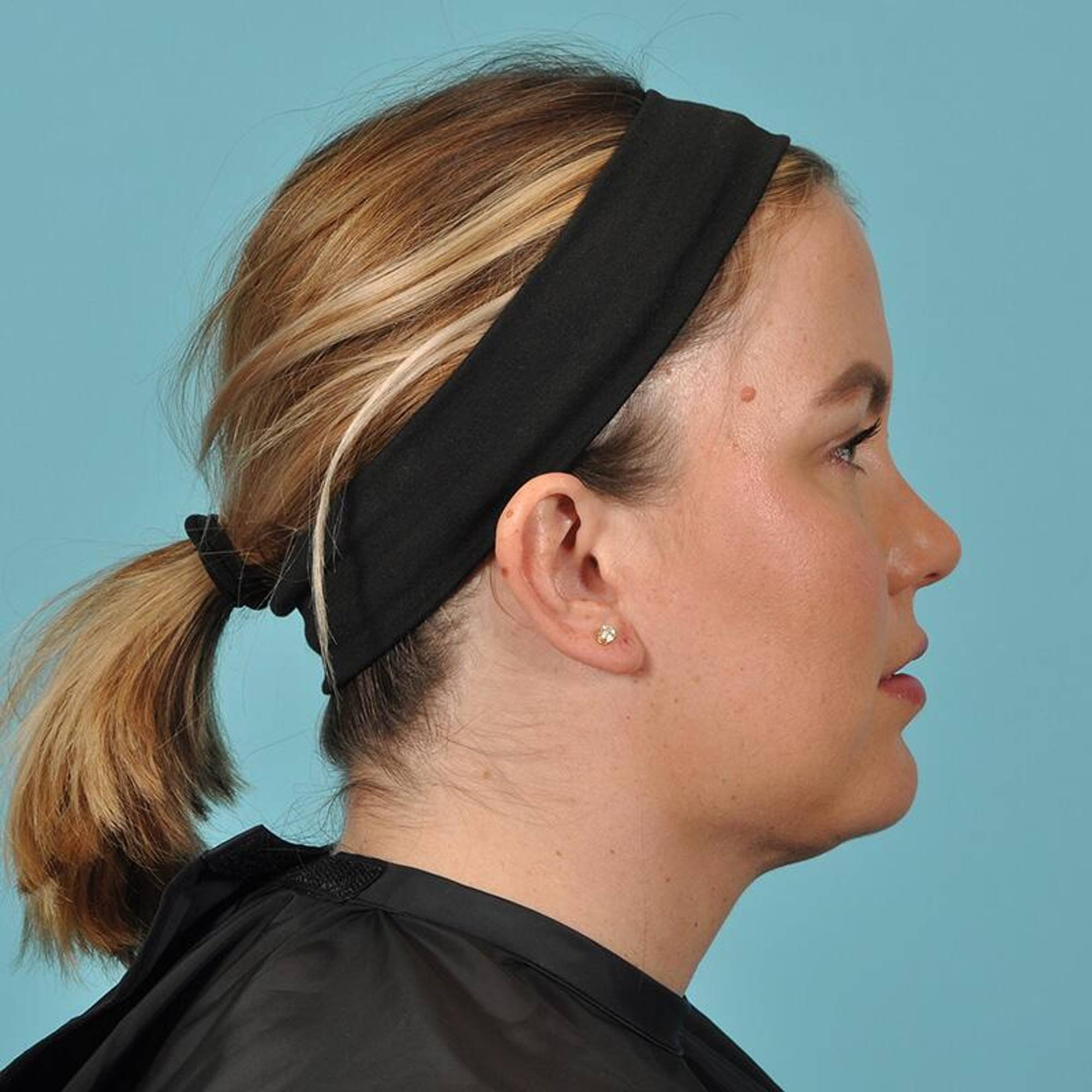 Liposuction Before & After Image