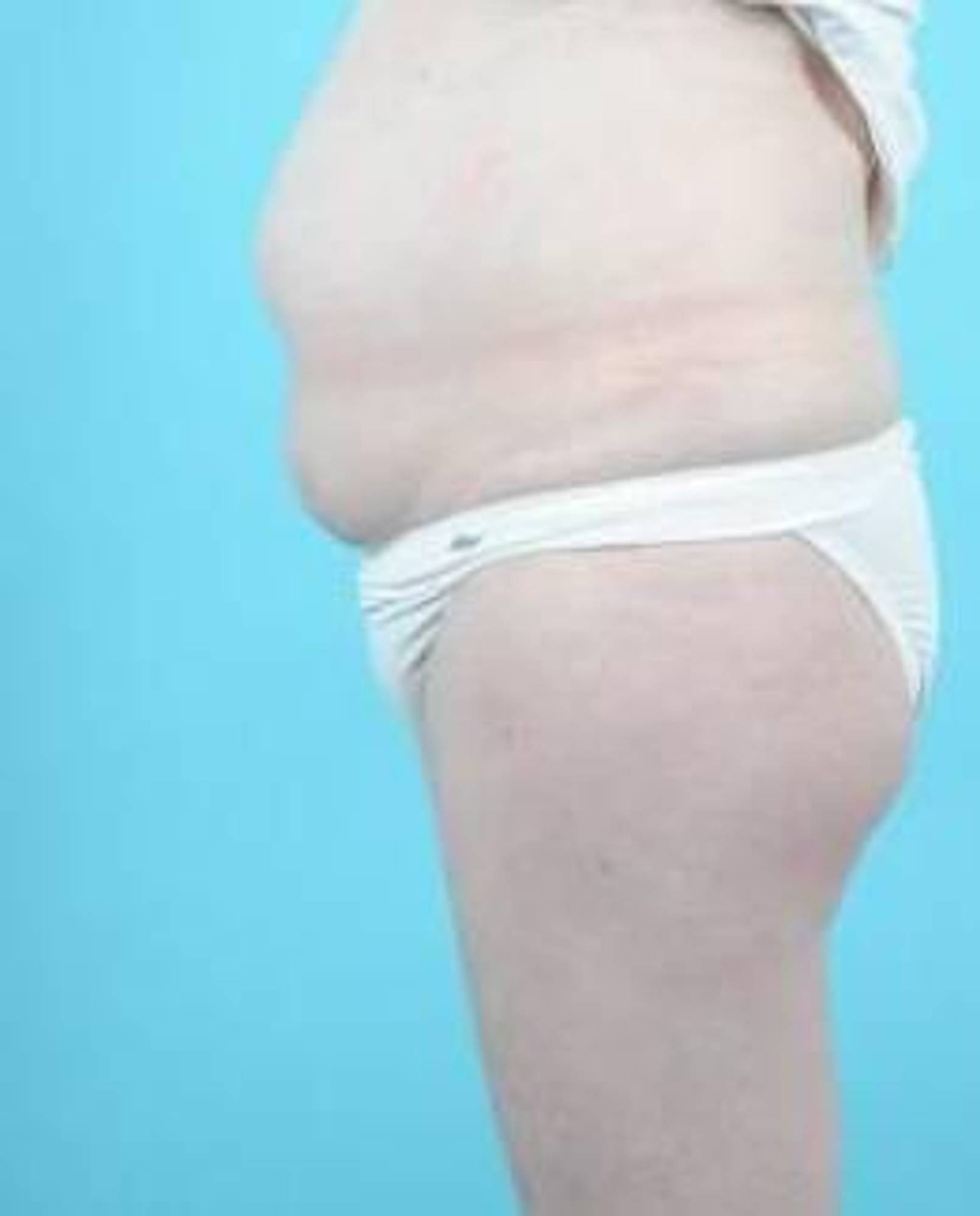 Liposuction Before & After Image