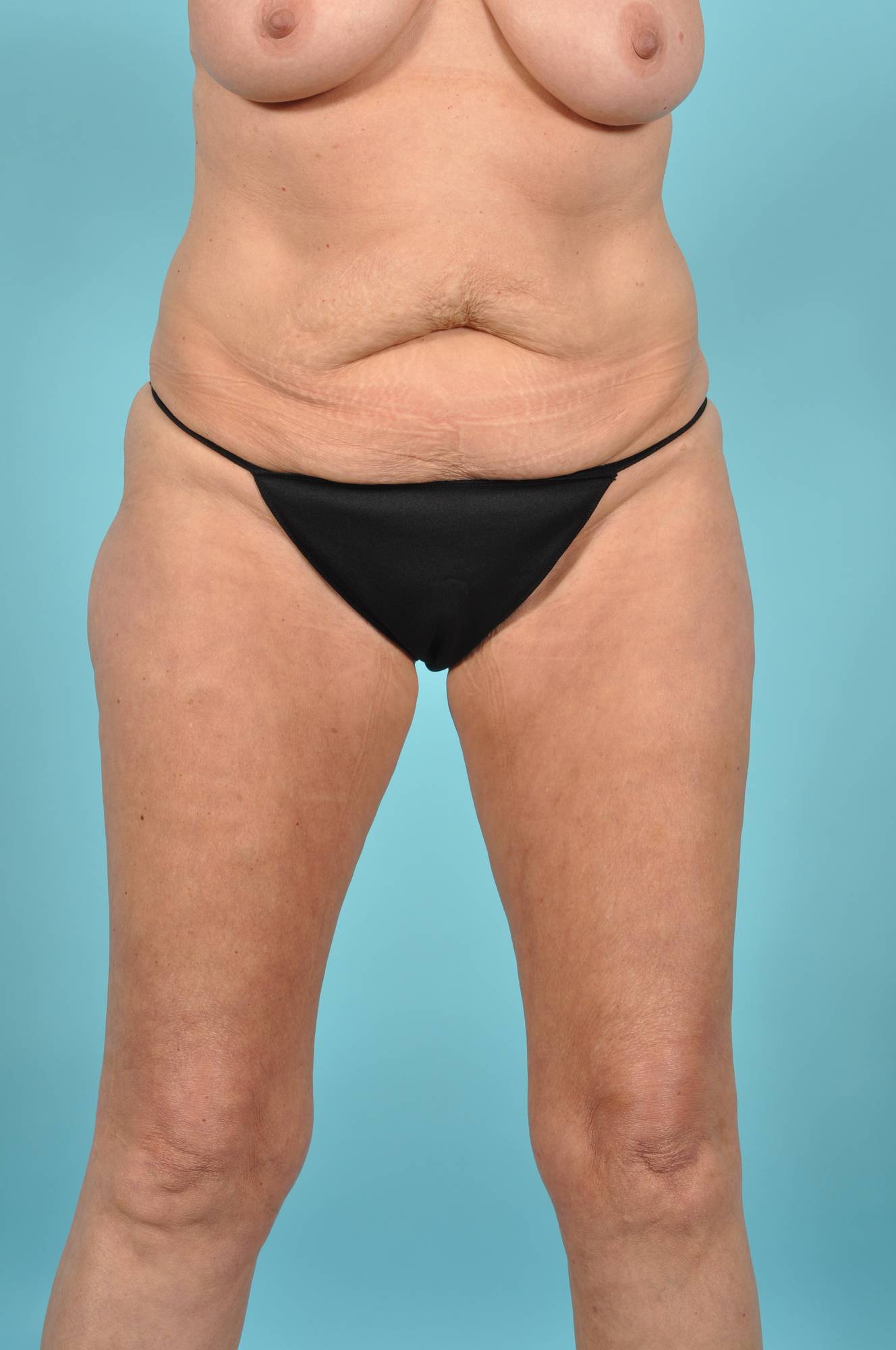 Liposuction Before & After Image