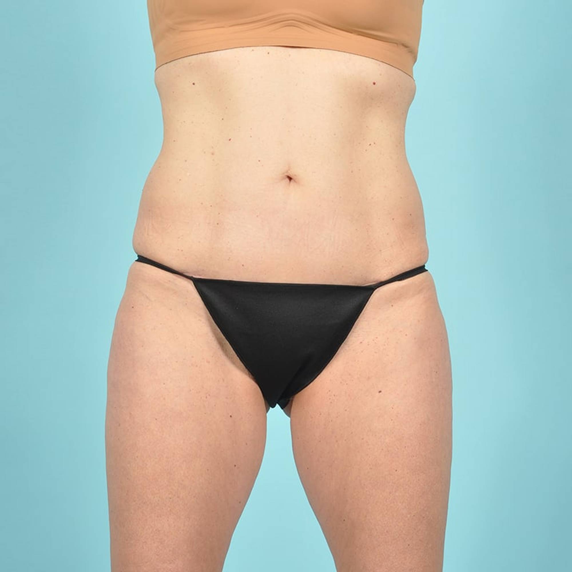 Liposuction Before & After Image