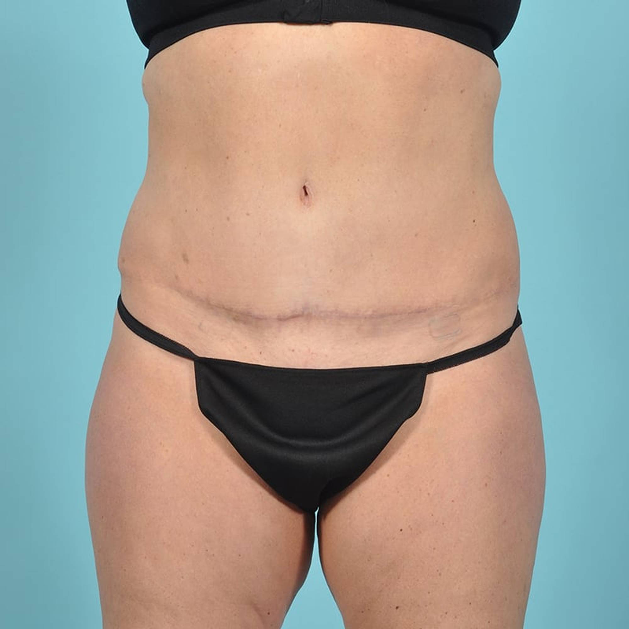 Liposuction Before & After Image