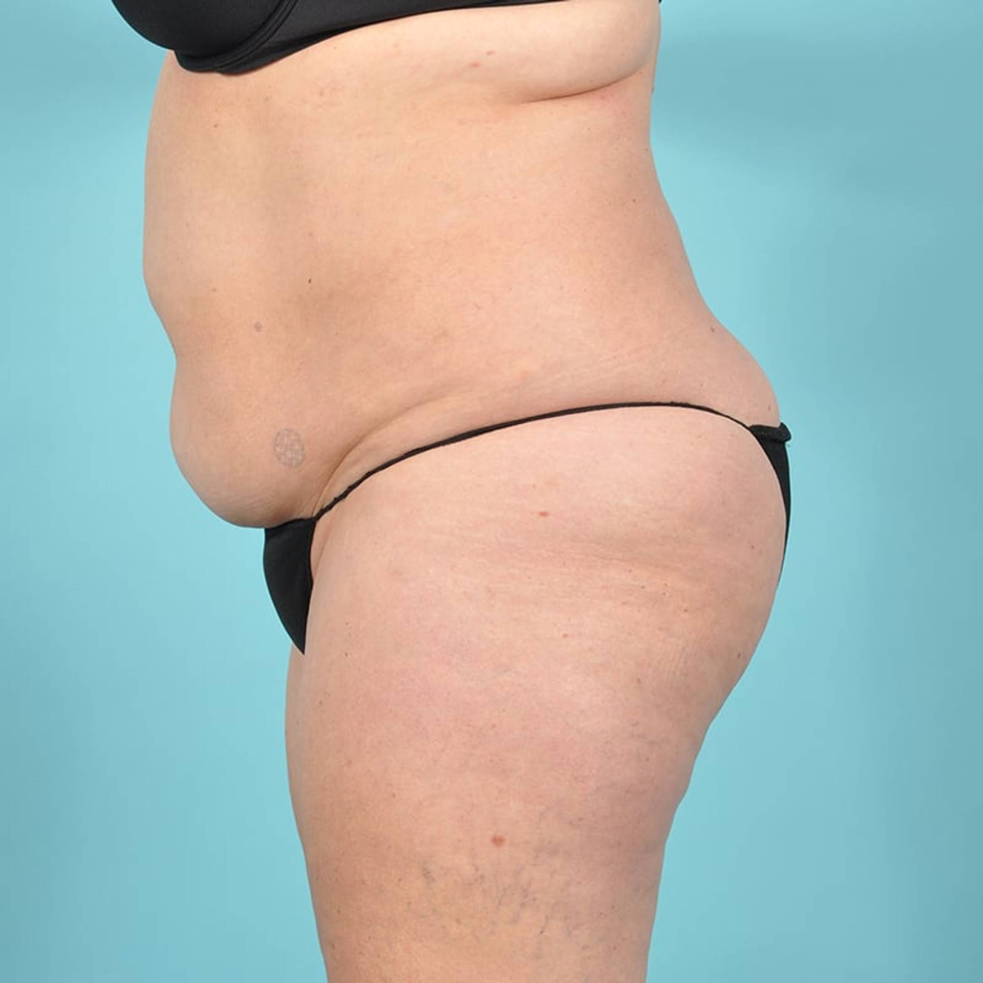 Liposuction Before & After Image