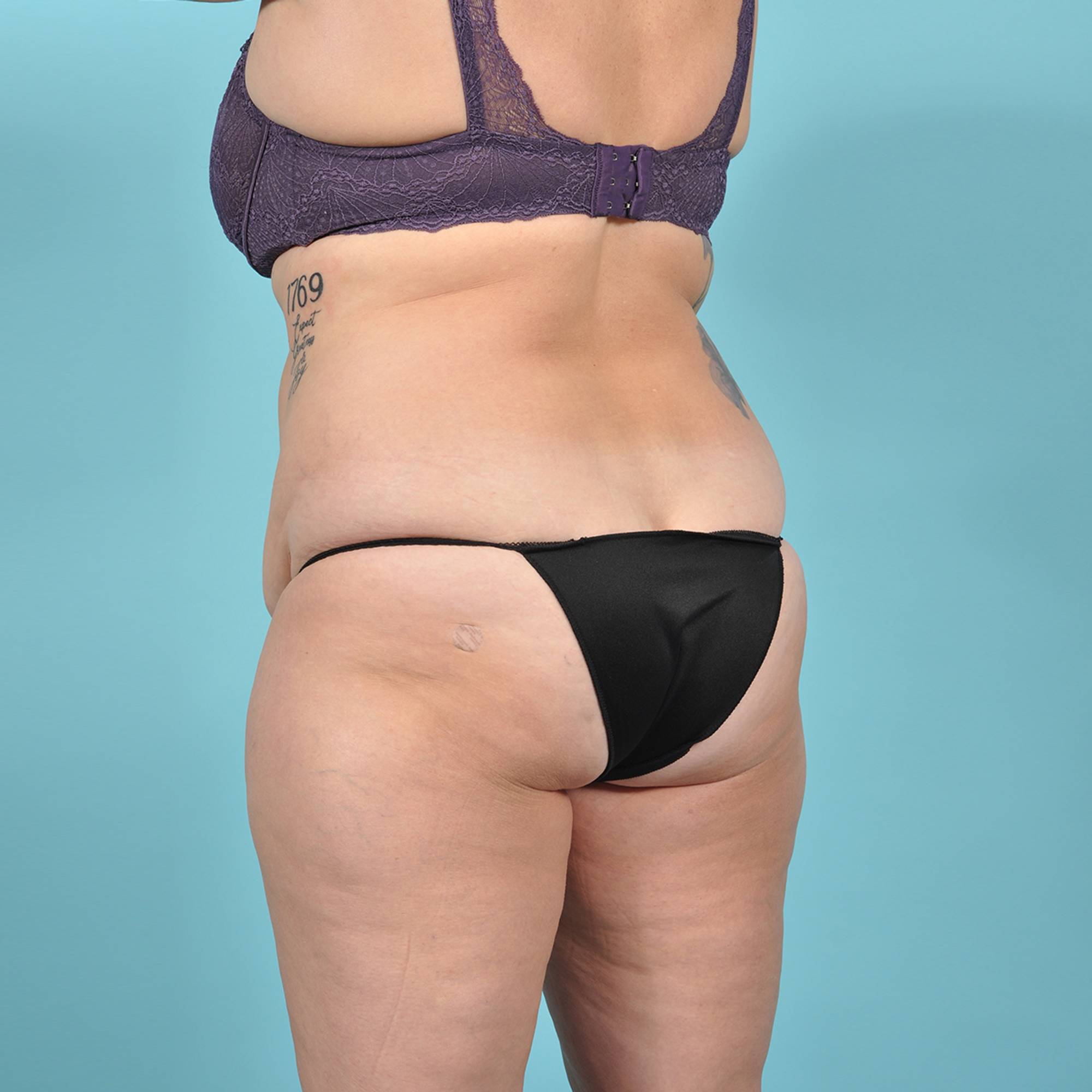 Liposuction Before & After Image