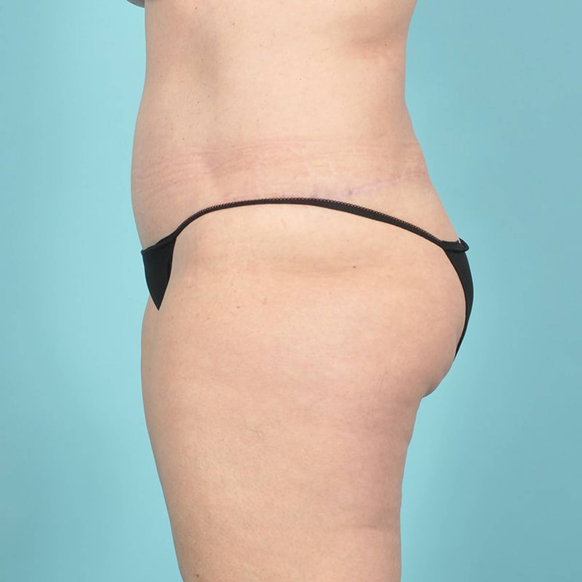Liposuction Before & After Image