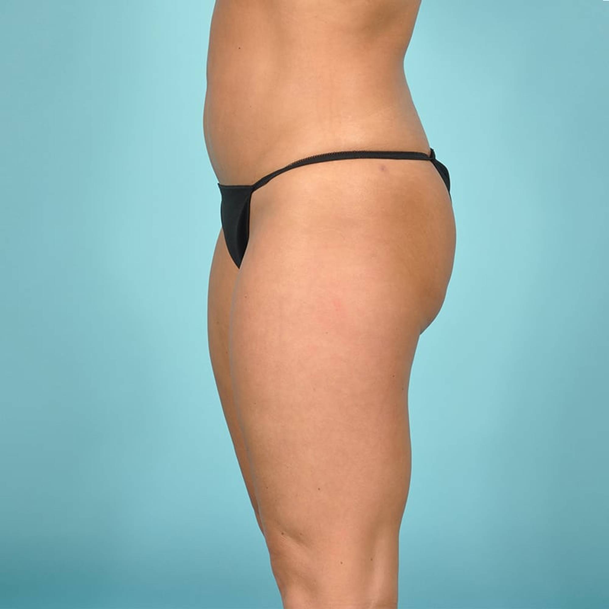 Liposuction Before & After Image