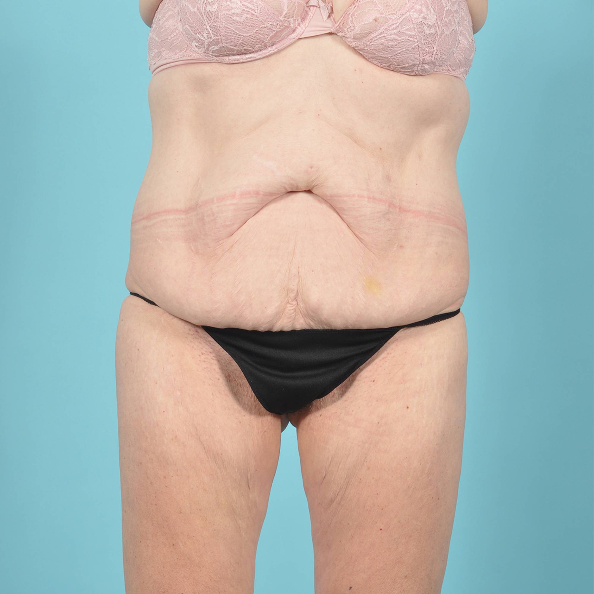 Liposuction Before & After Image