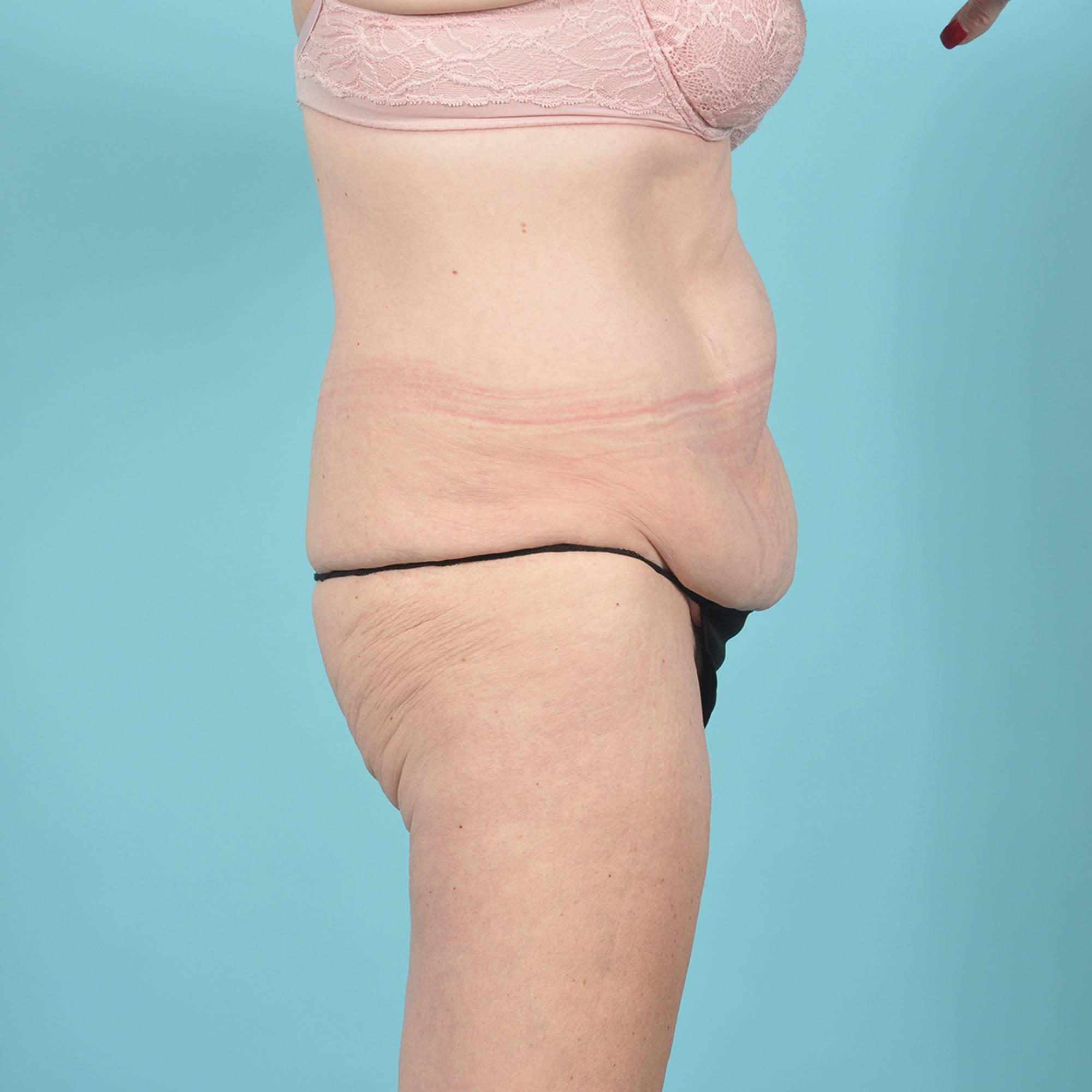 Liposuction Before & After Image