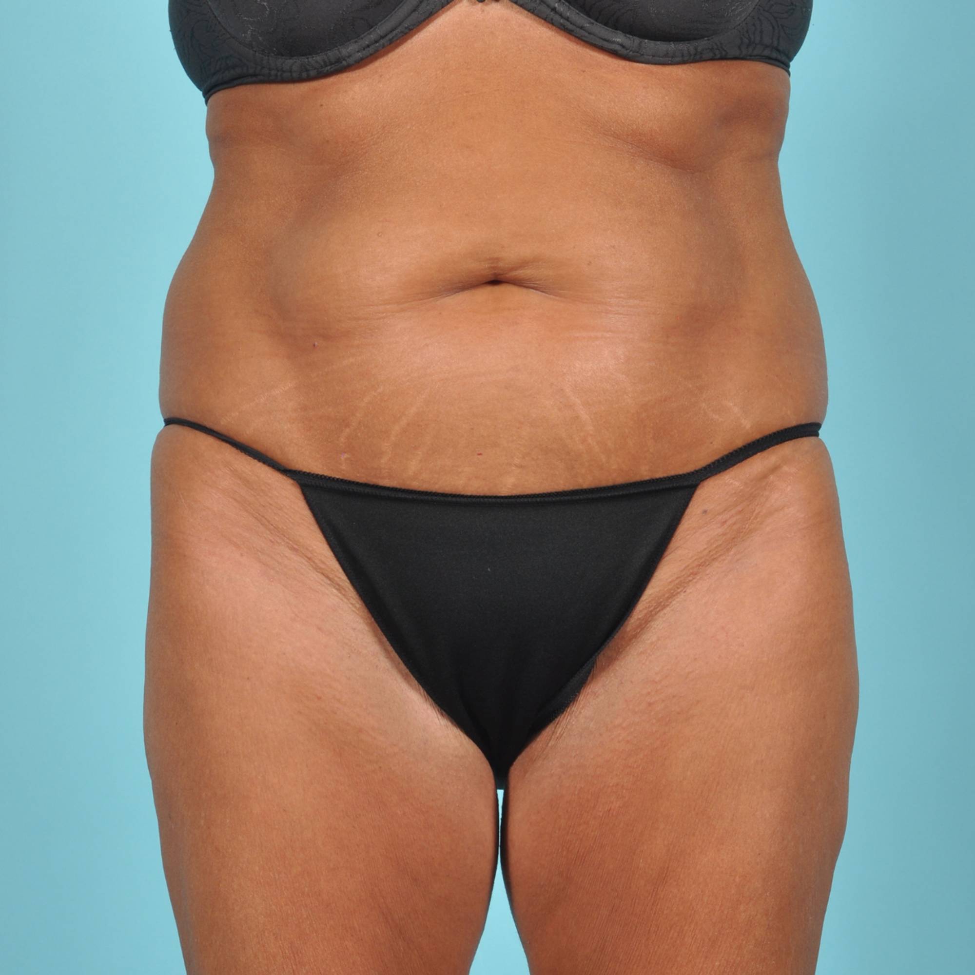 Liposuction Before & After Image