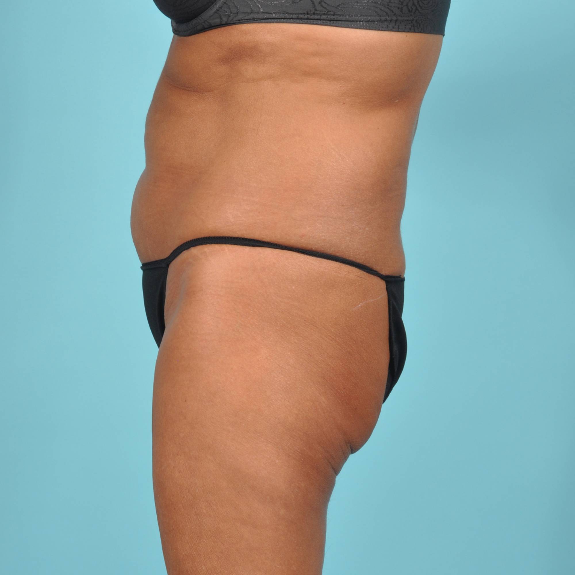 Liposuction Before & After Image