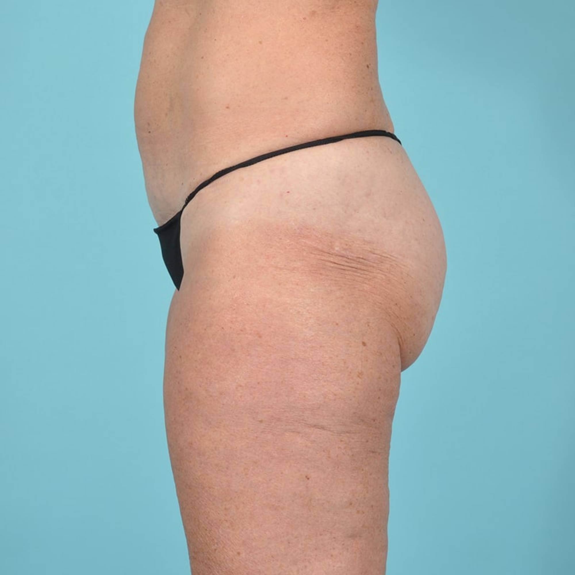 Liposuction Before & After Image
