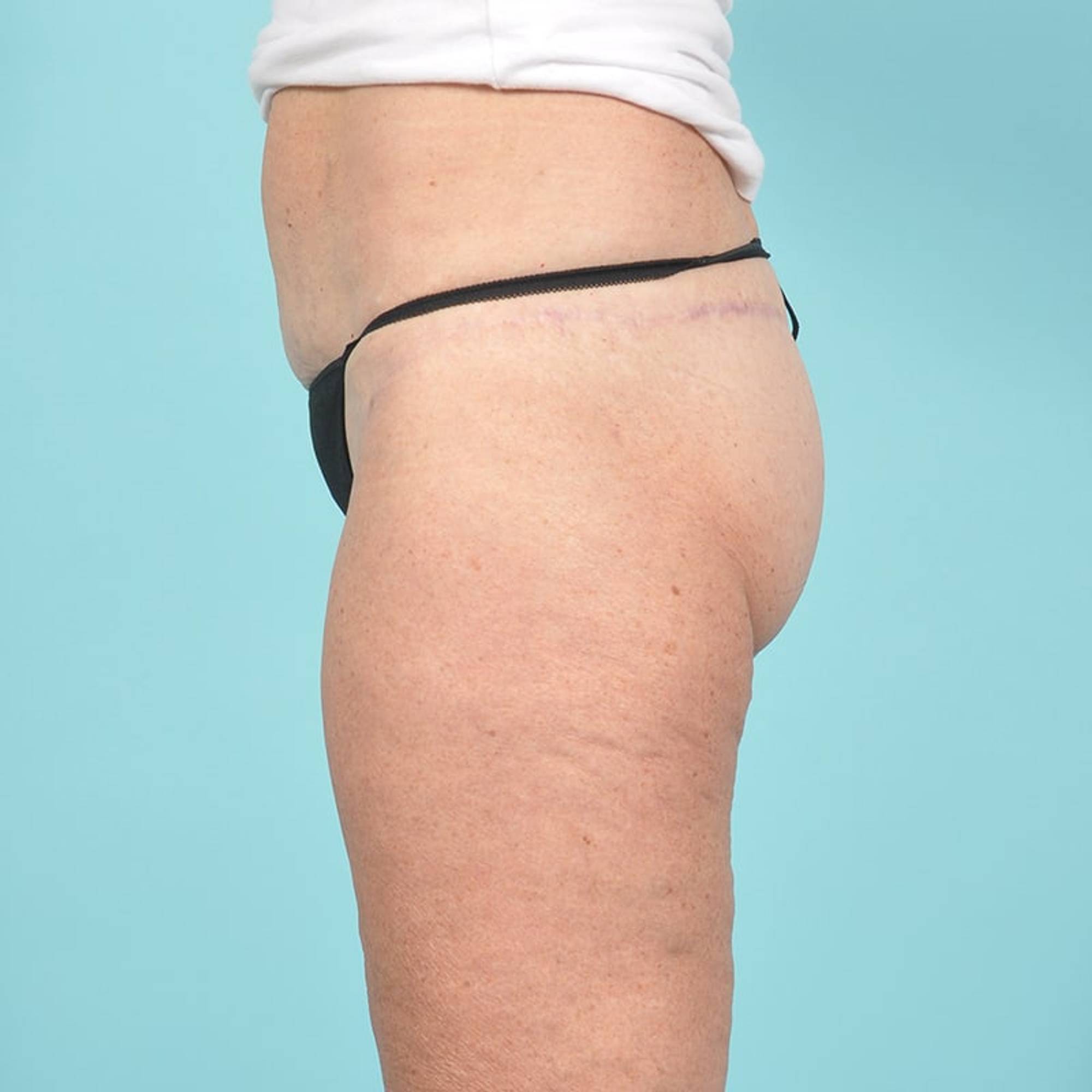 Liposuction Before & After Image