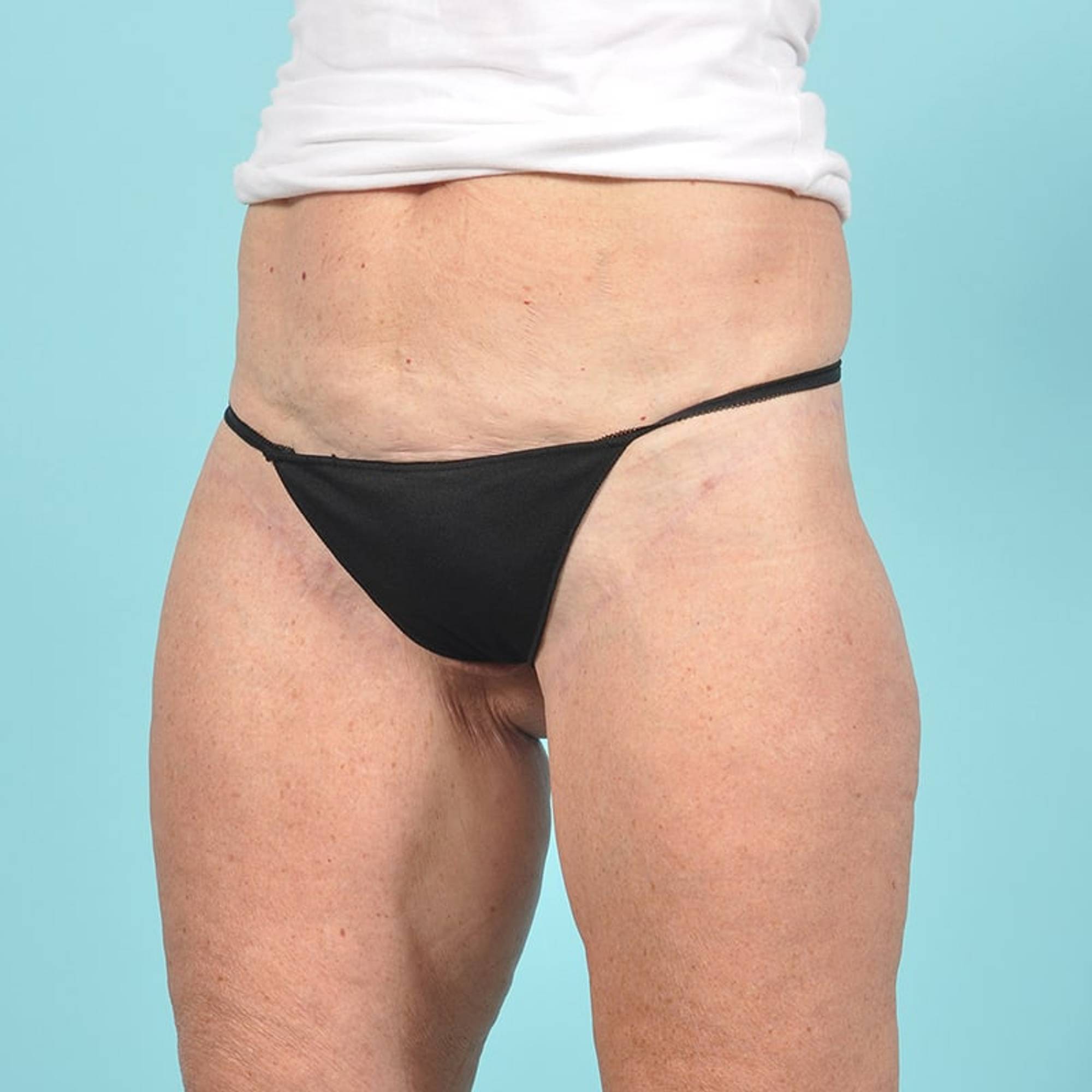 Liposuction Before & After Image