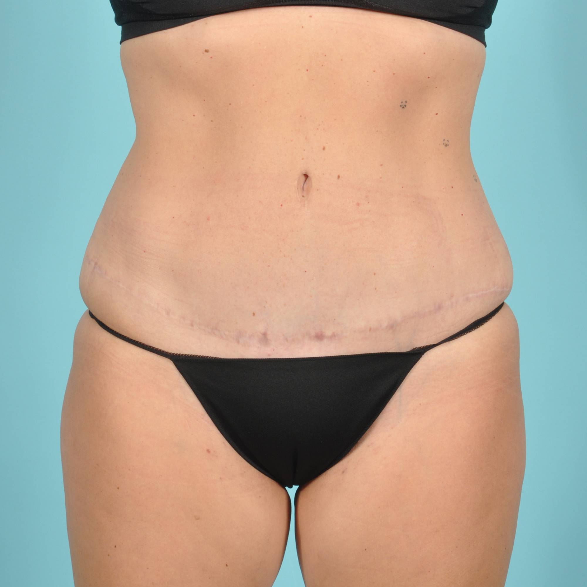 Liposuction Before & After Image