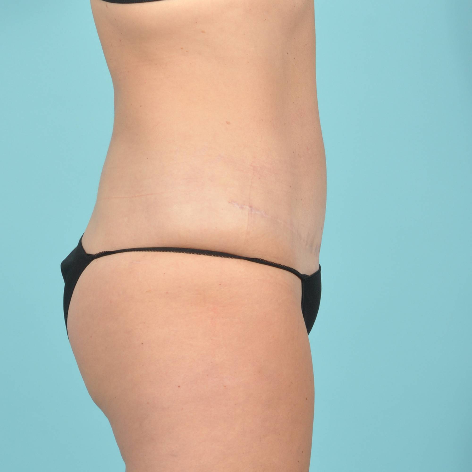 Liposuction Before & After Image