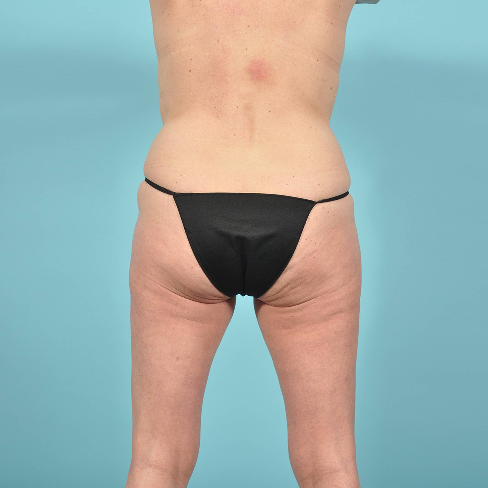 Liposuction Before & After Image