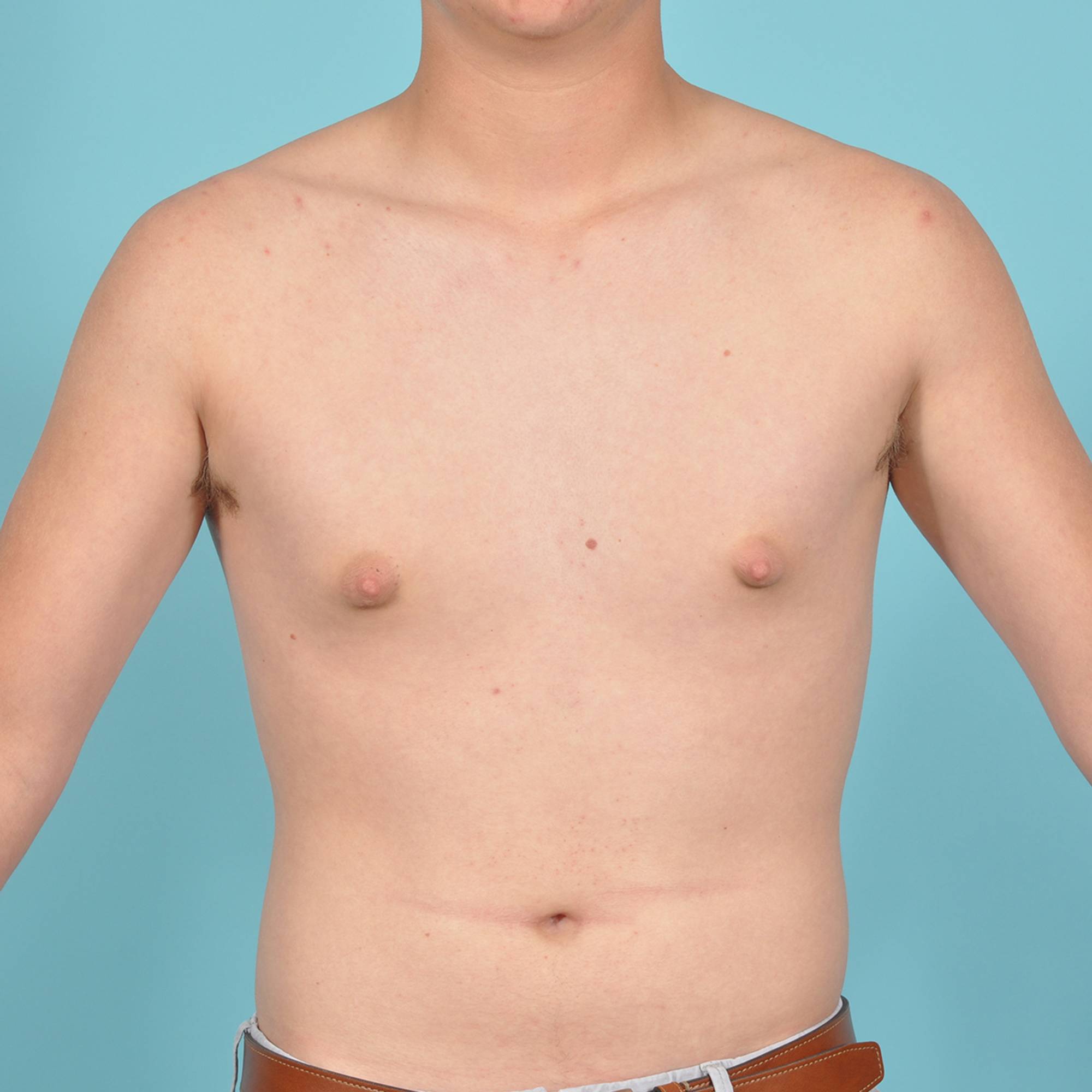 Liposuction Before & After Image