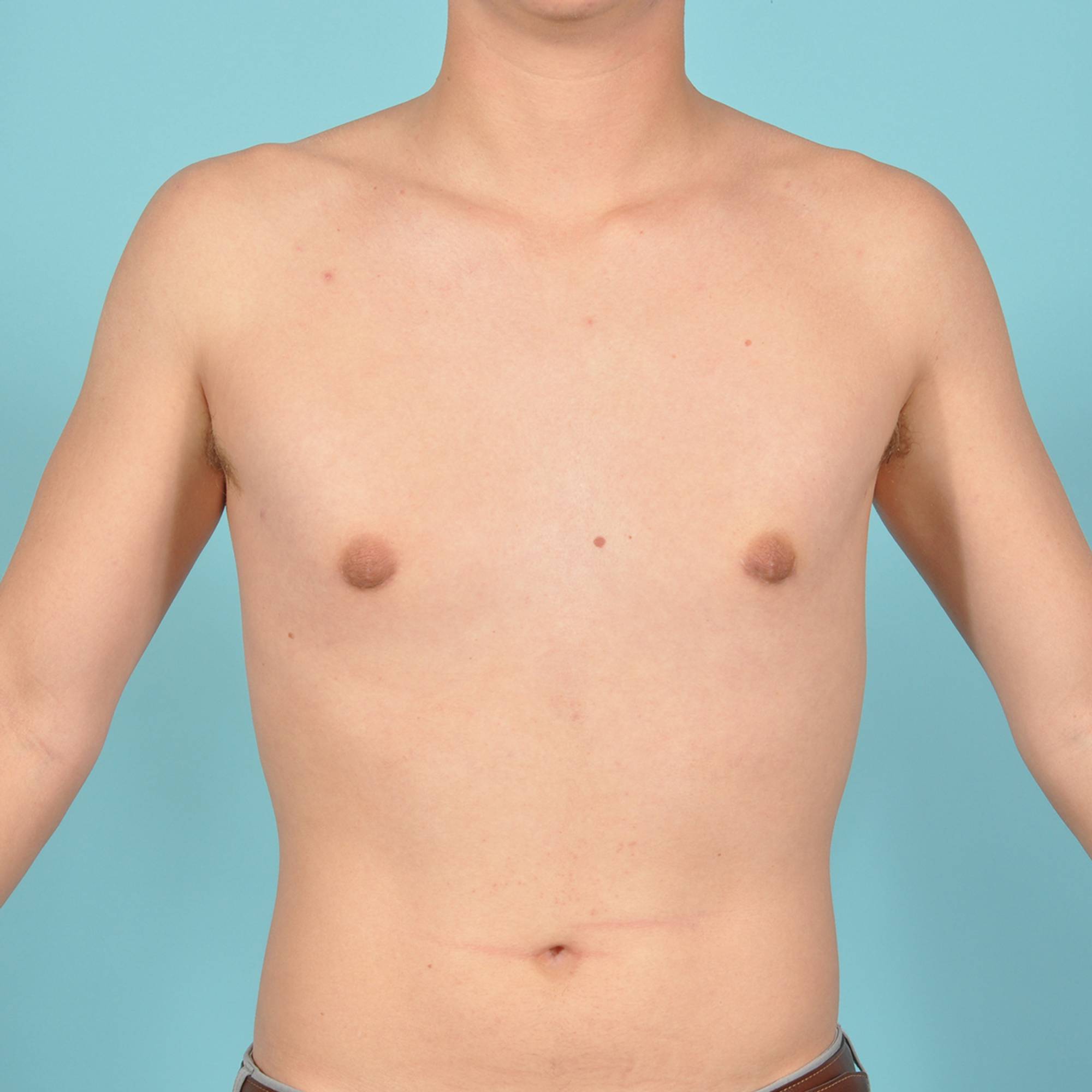 Liposuction Before & After Image