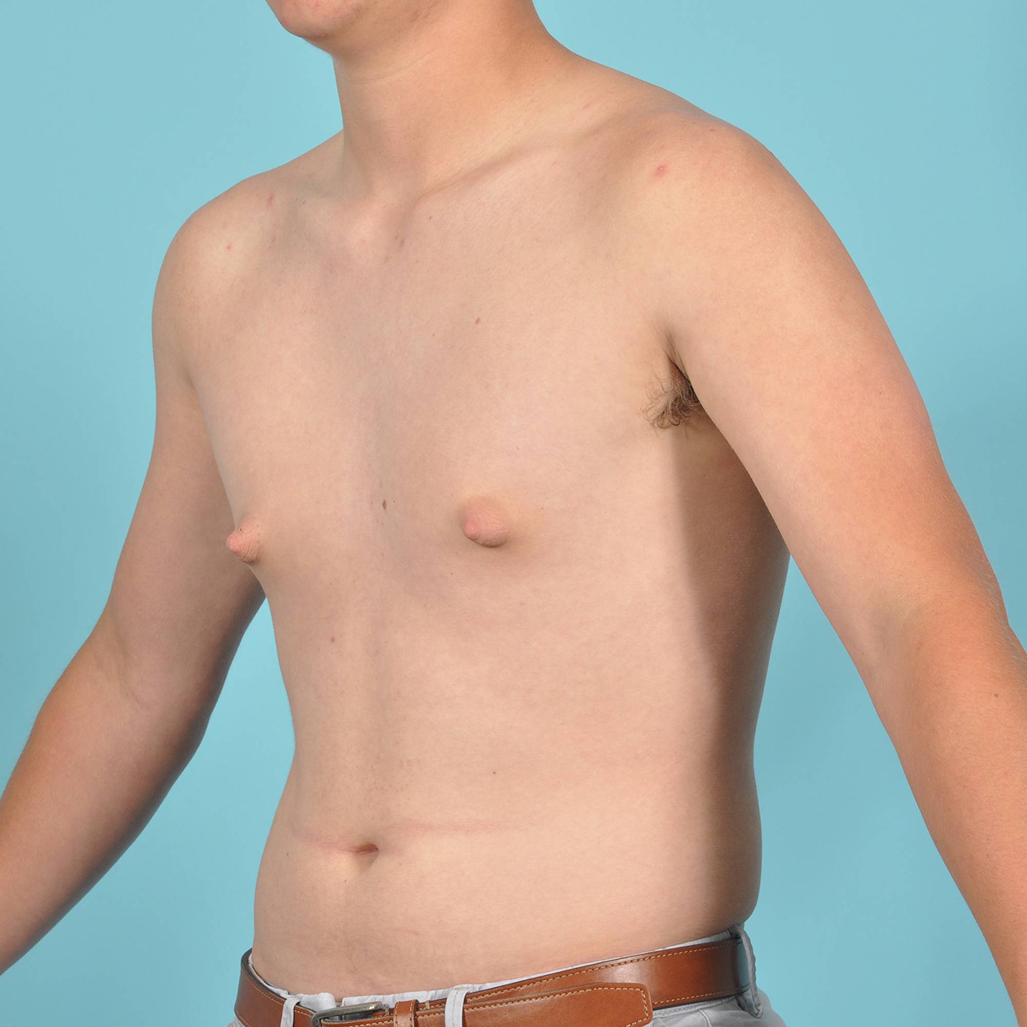 Liposuction Before & After Image