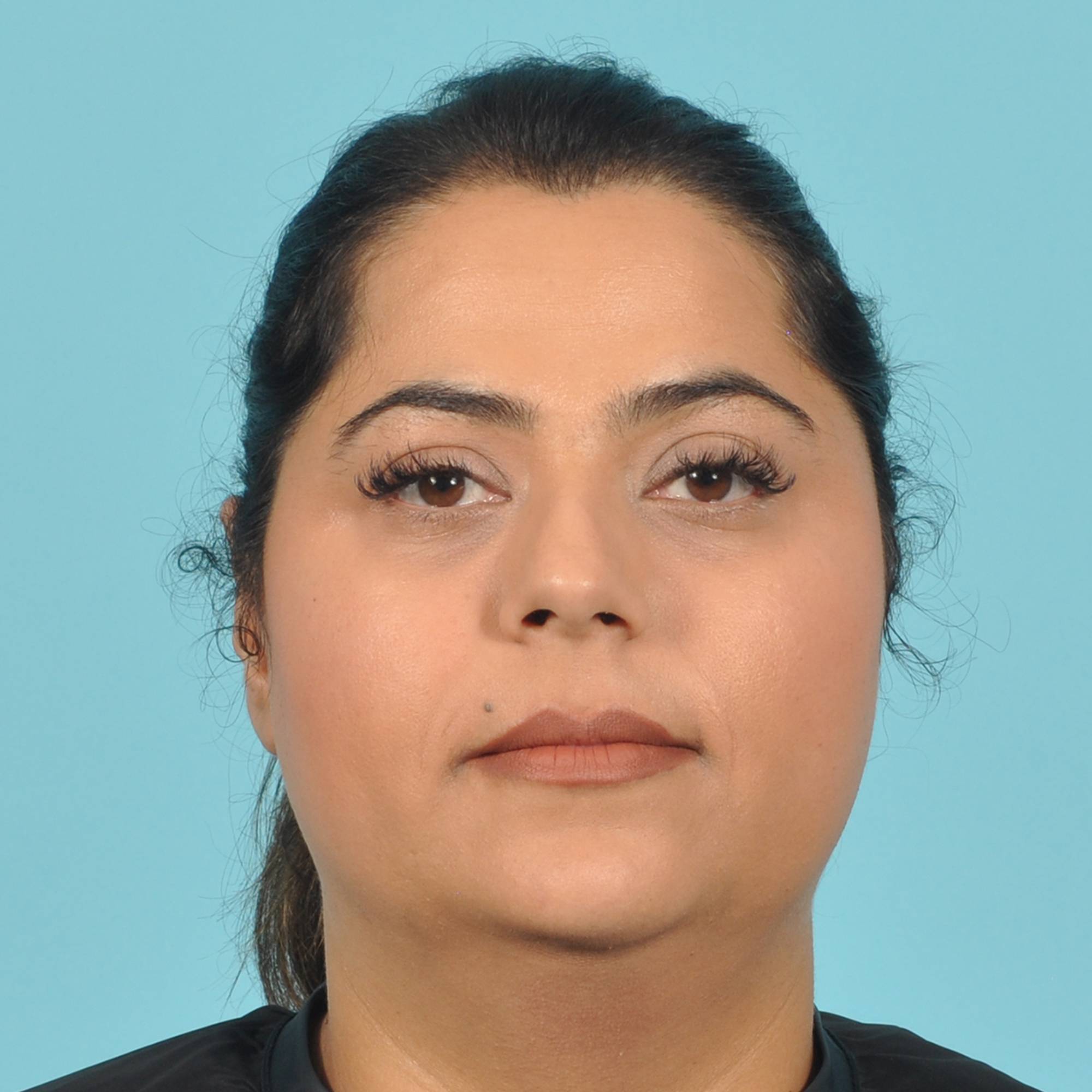 Liposuction Before & After Image