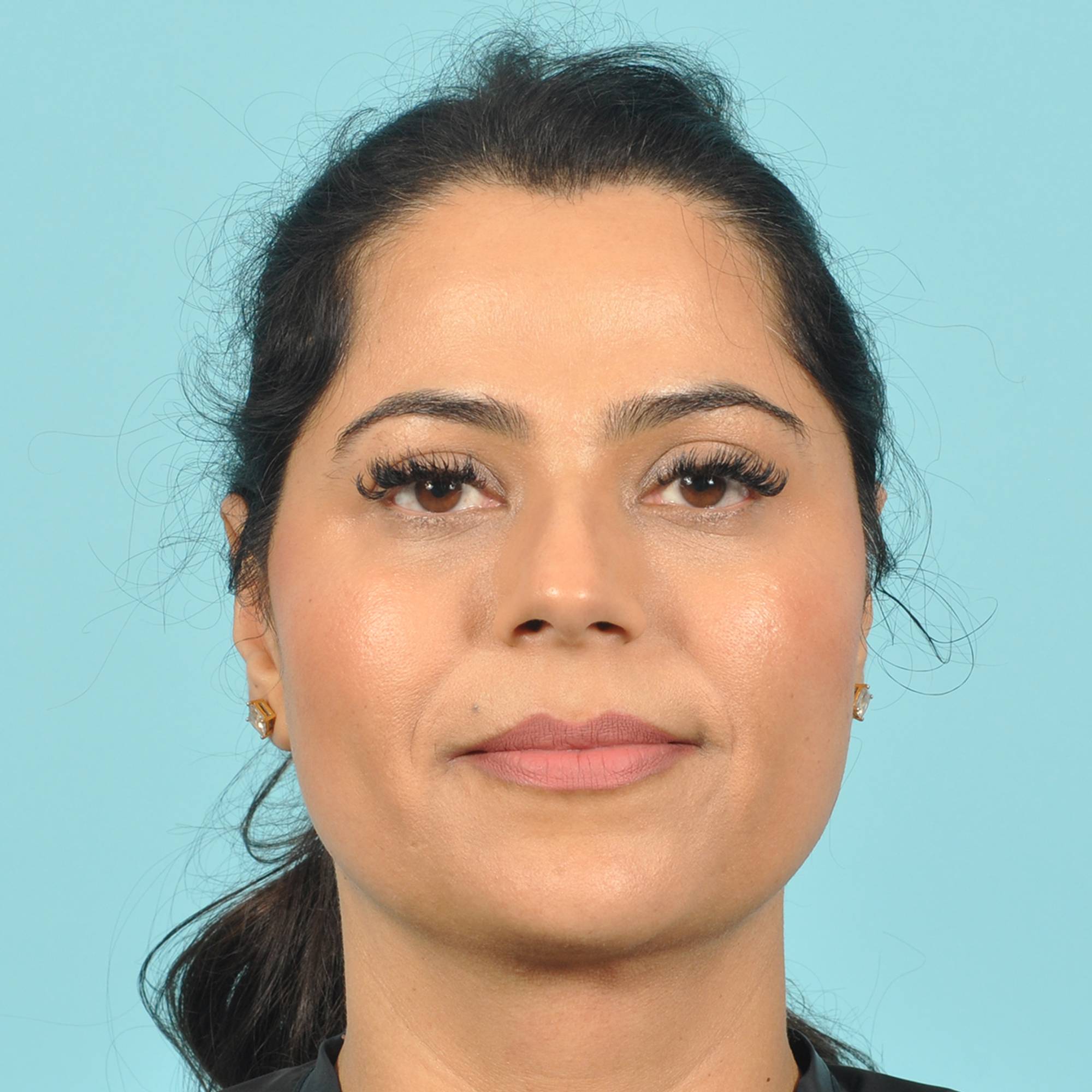 Liposuction Before & After Image