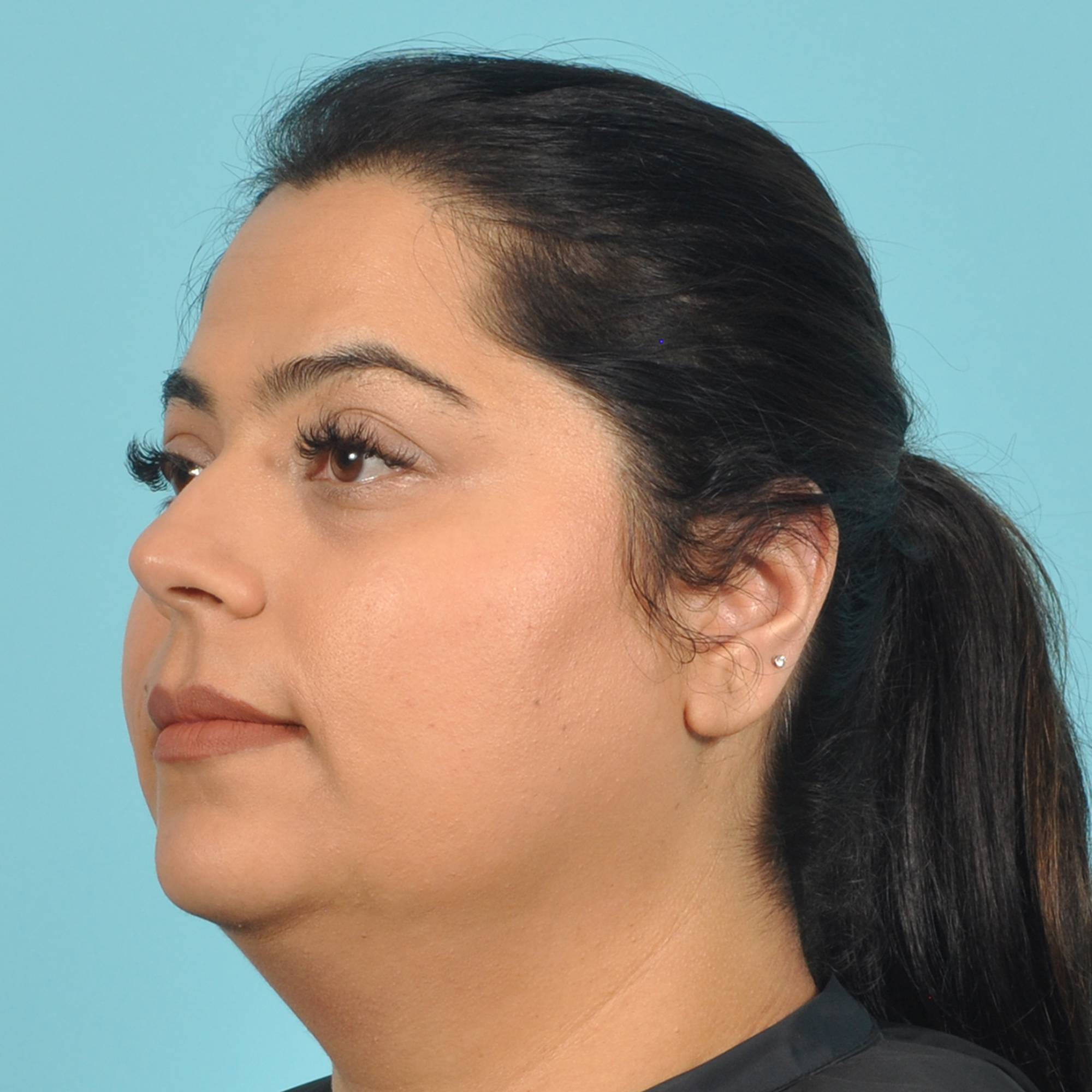 Liposuction Before & After Image