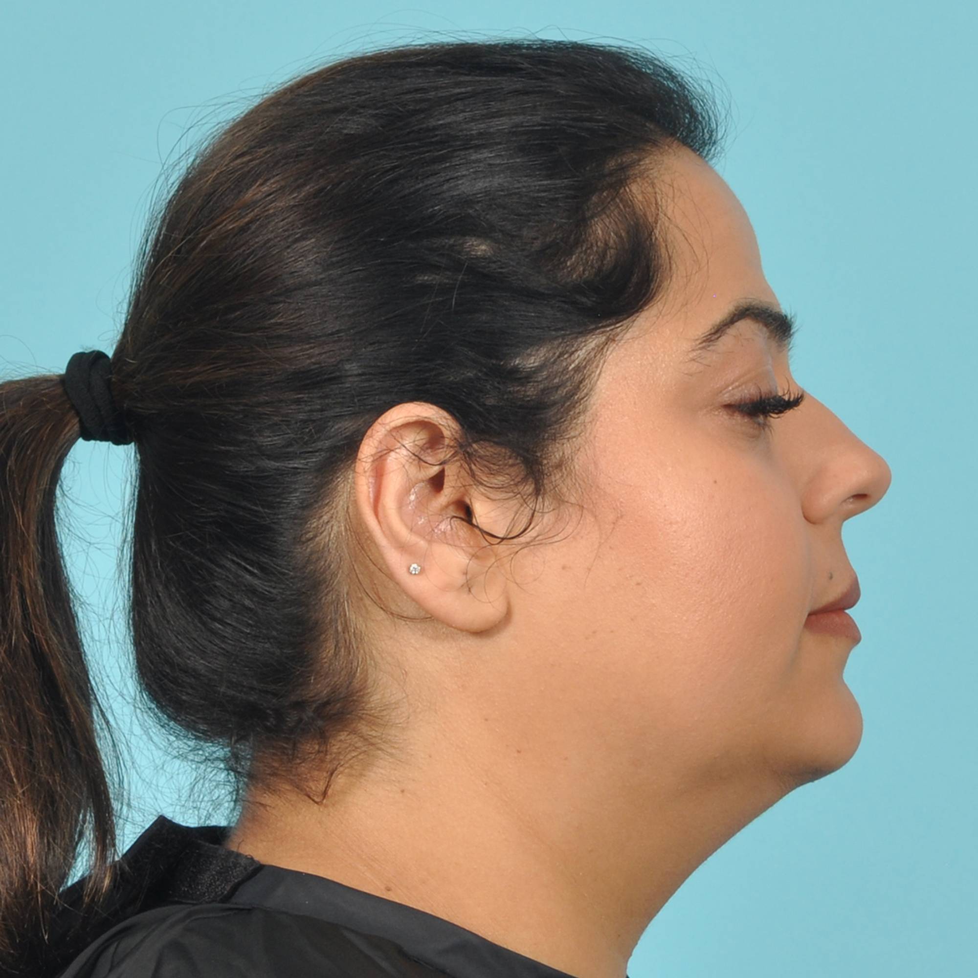 Liposuction Before & After Image