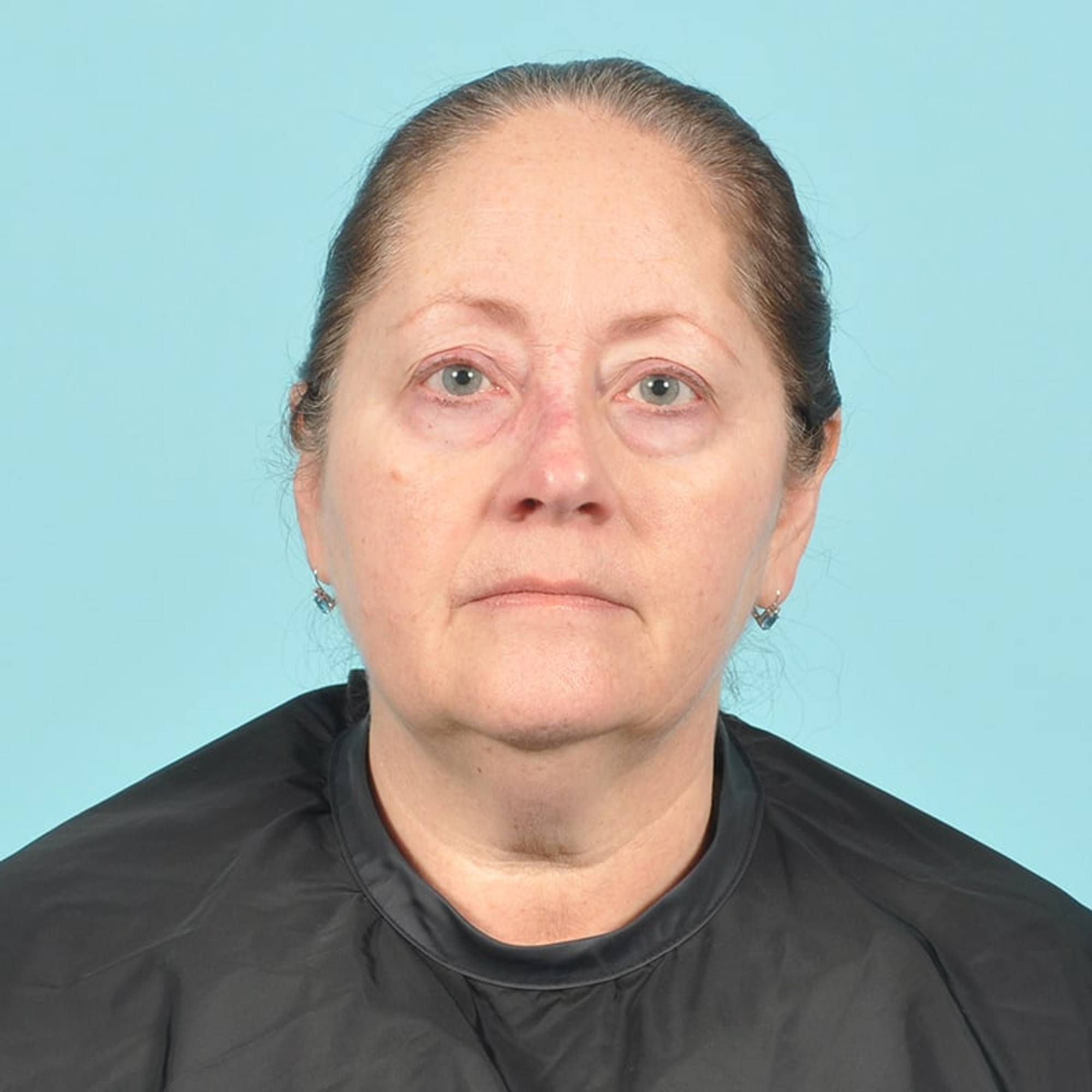 Liposuction Before & After Image