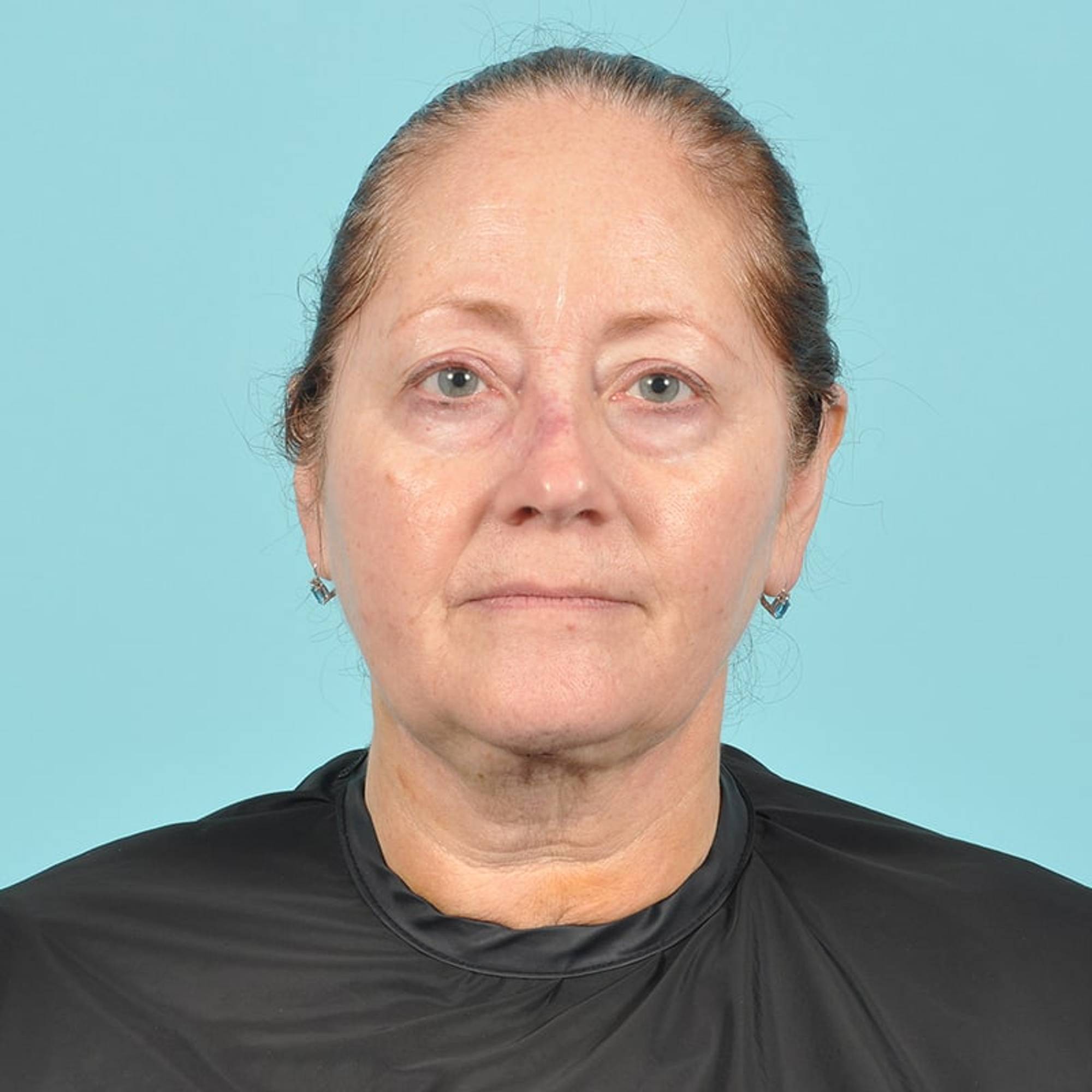 Liposuction Before & After Image