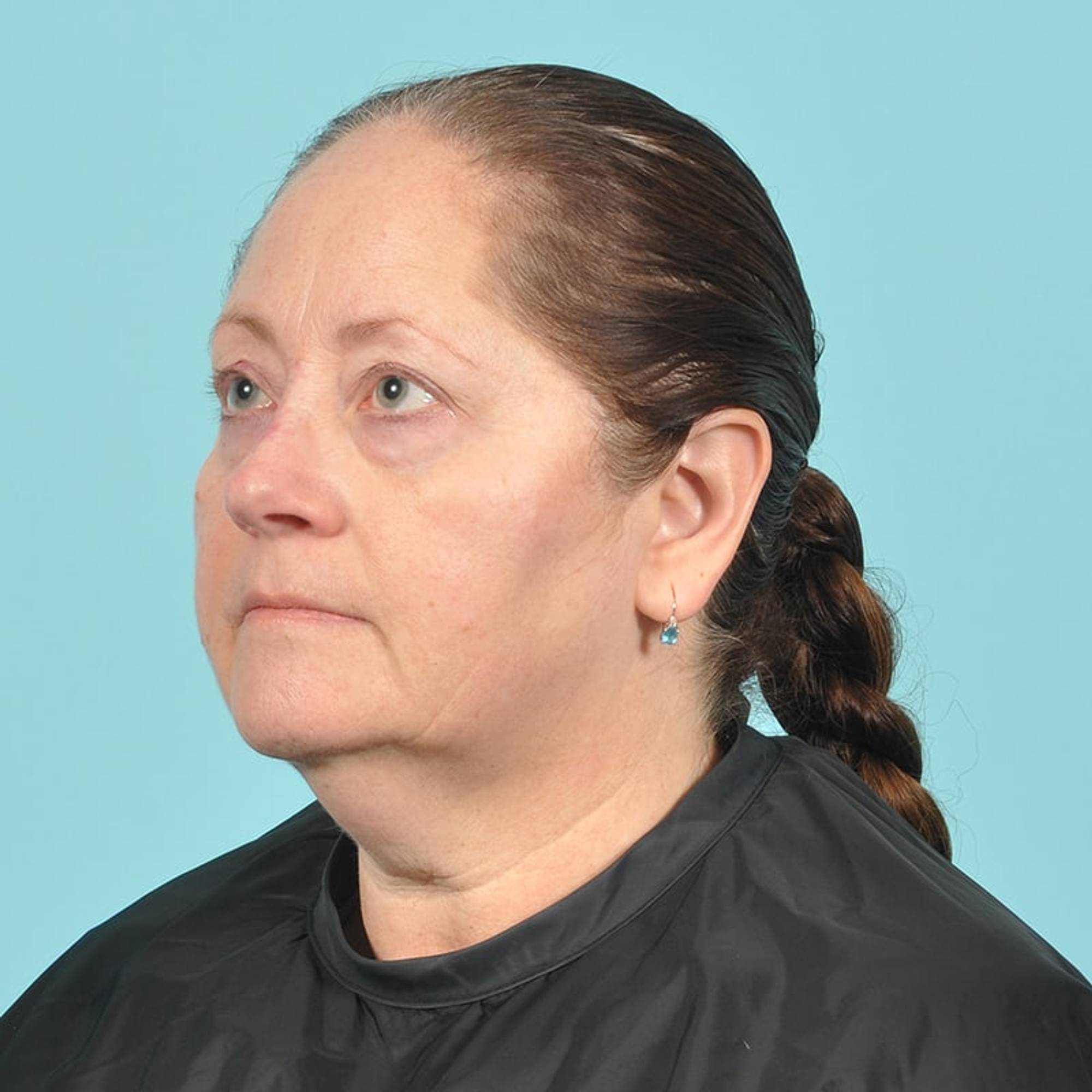 Liposuction Before & After Image