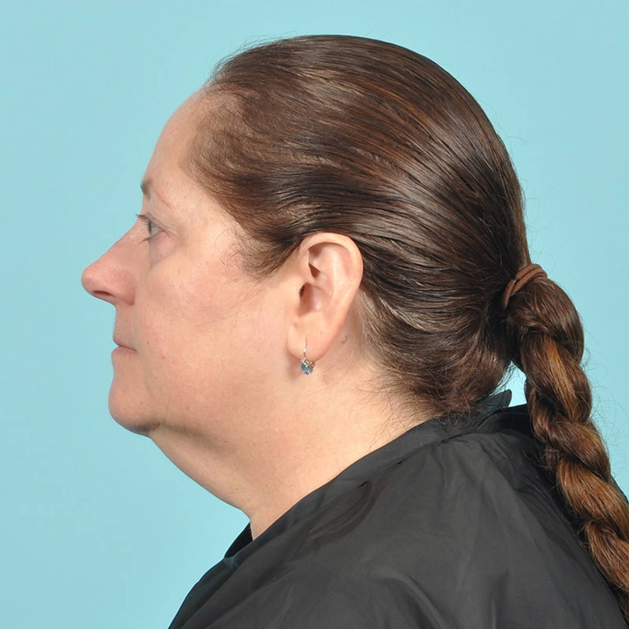 Liposuction Before & After Image