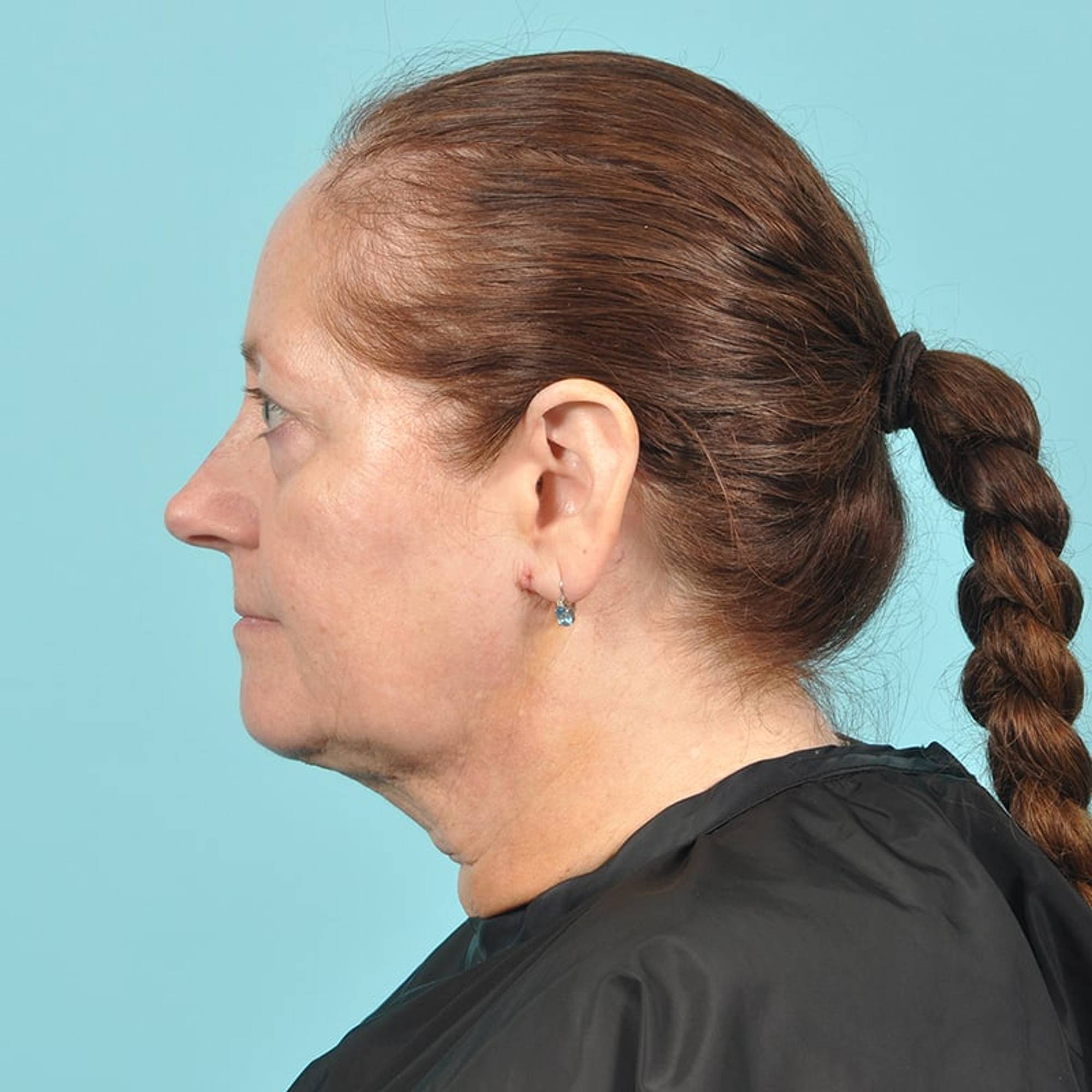 Liposuction Before & After Image