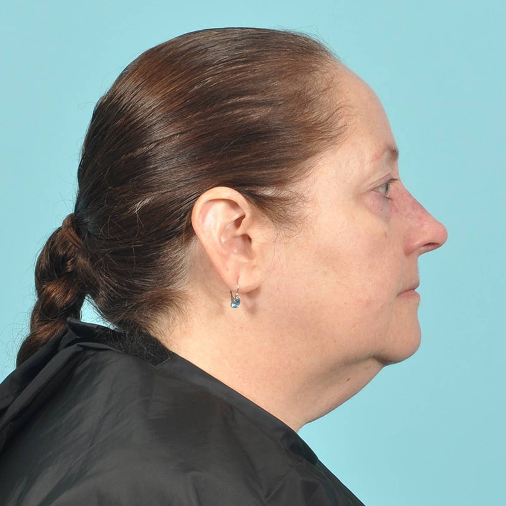  Before & After Image