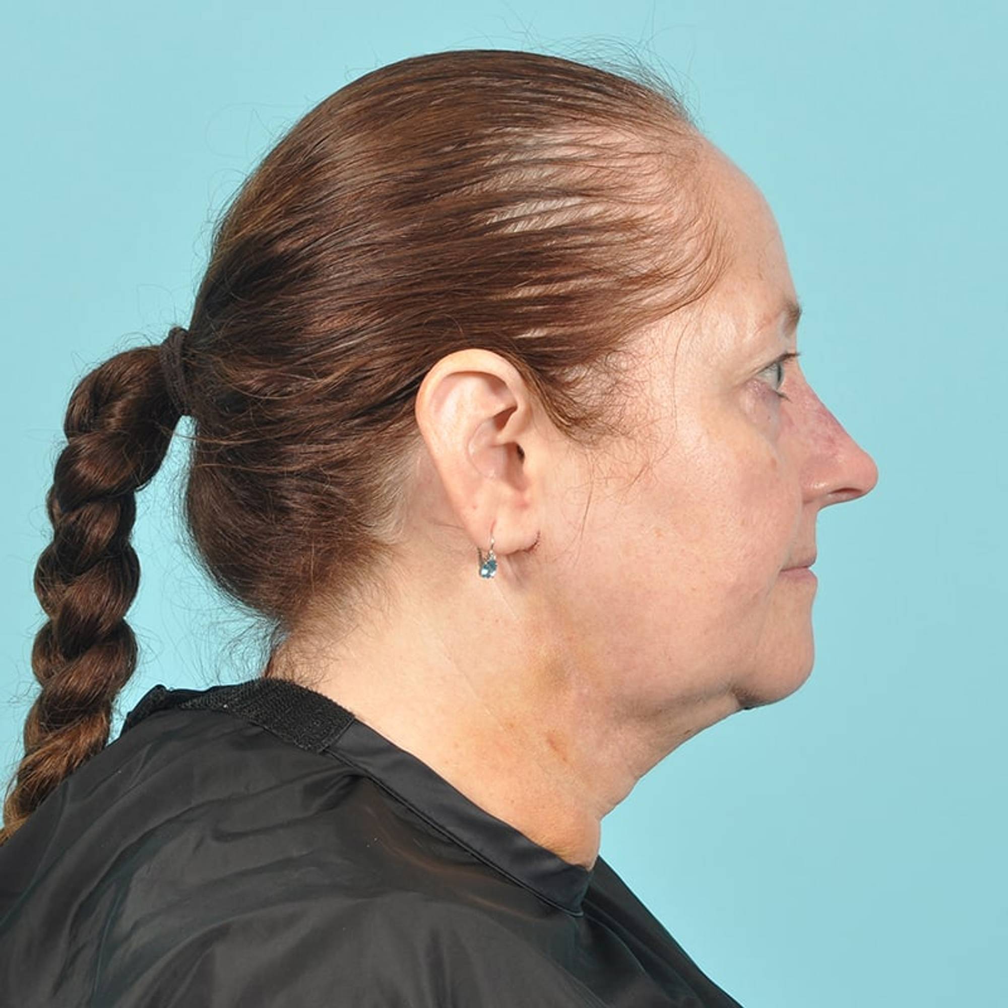  Before & After Image