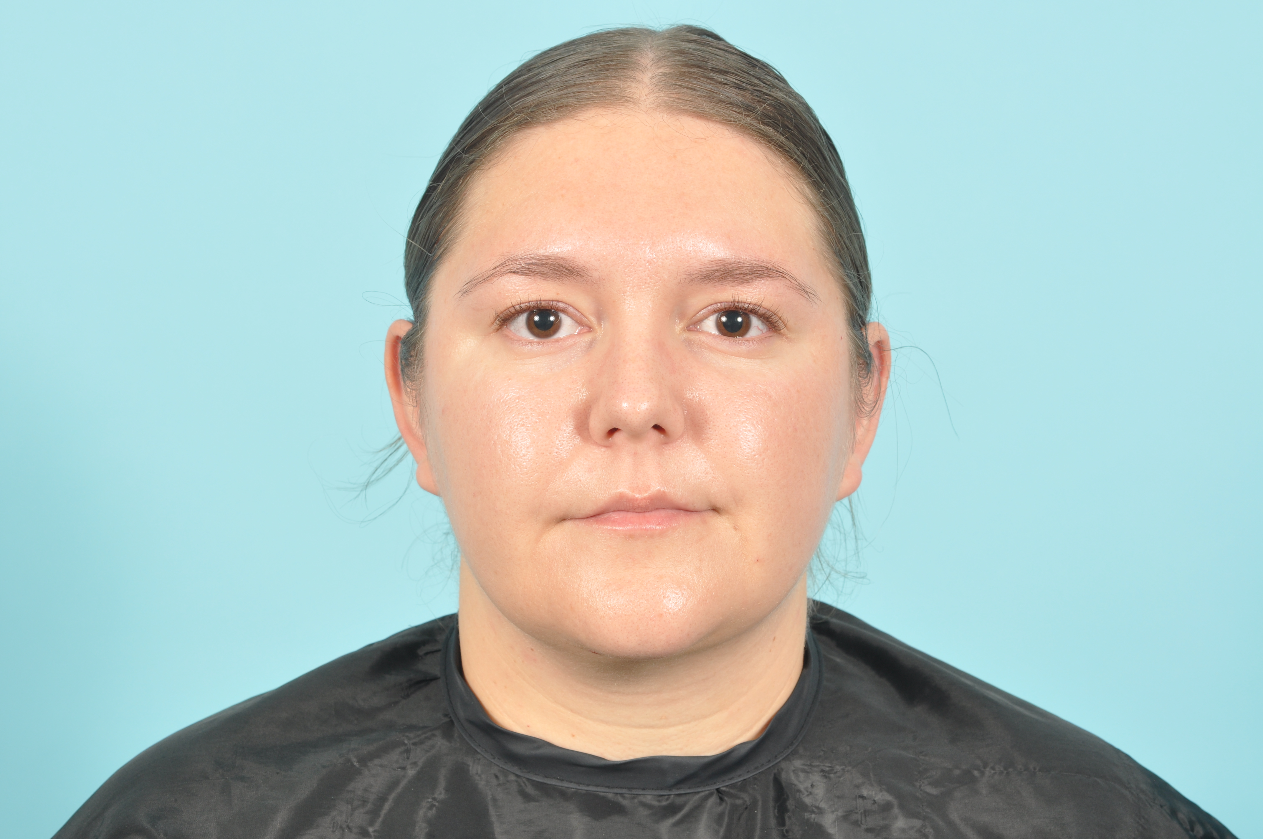 Liposuction Before & After Image