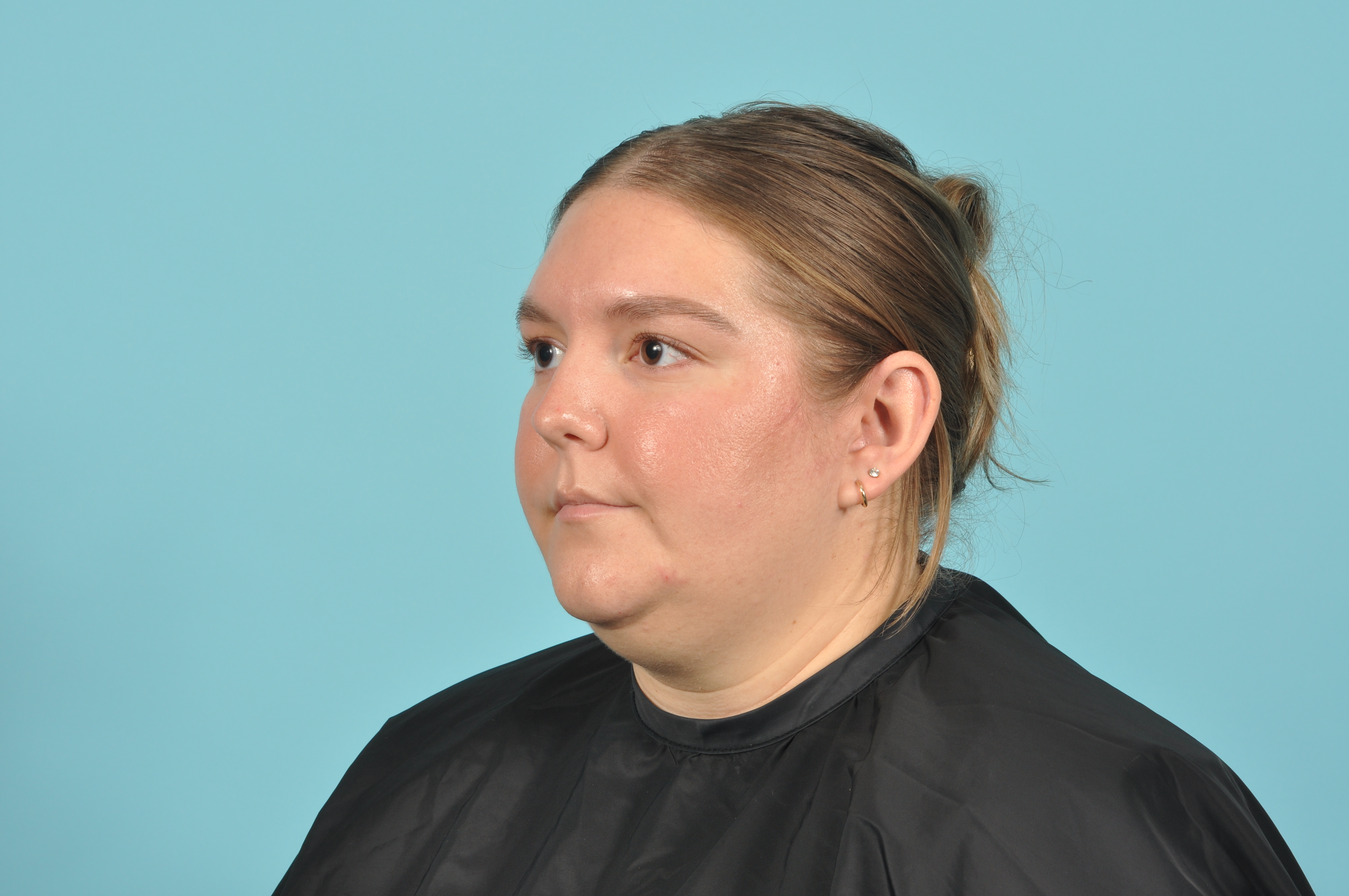 Liposuction Before & After Image