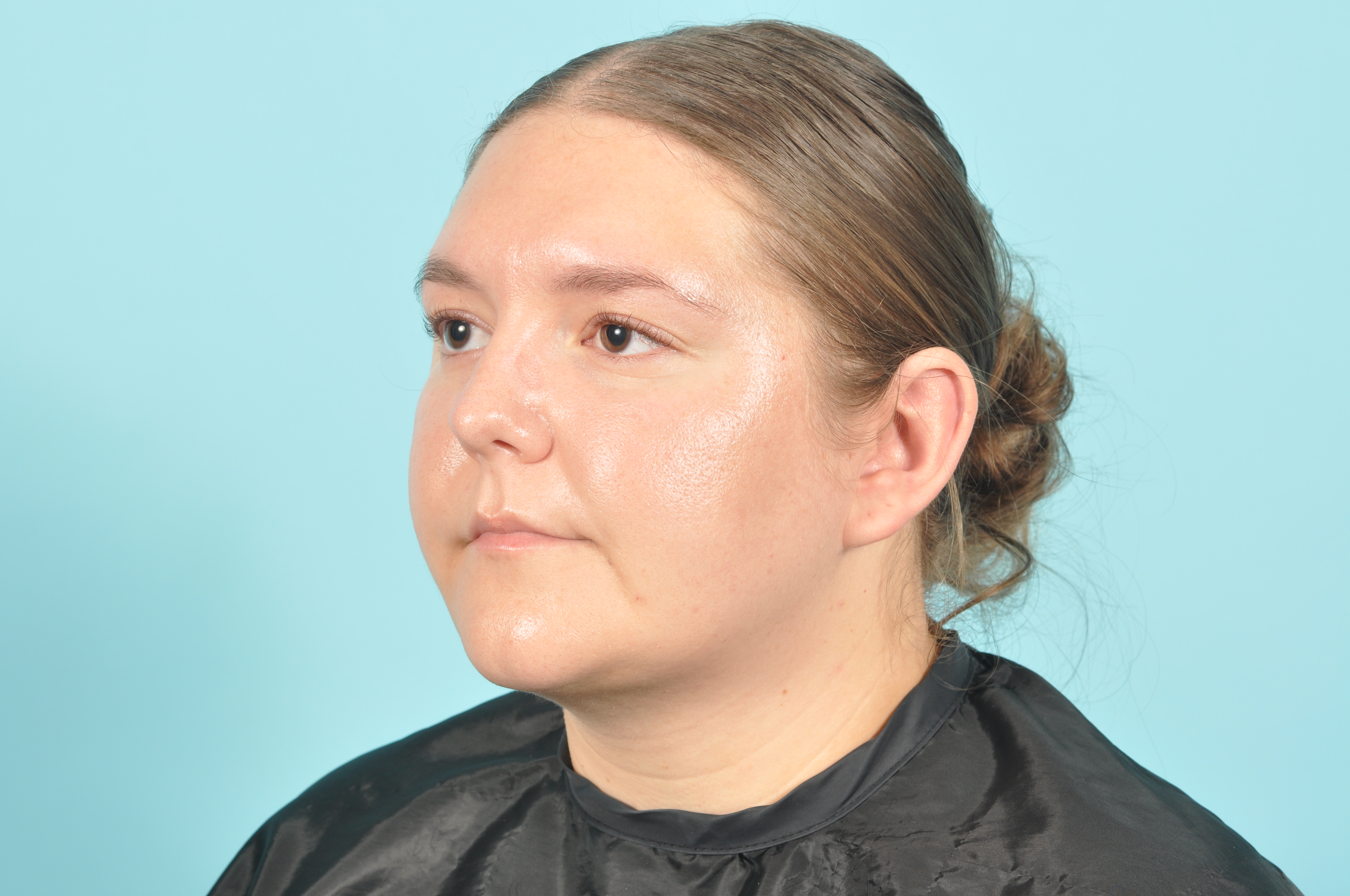 Liposuction Before & After Image