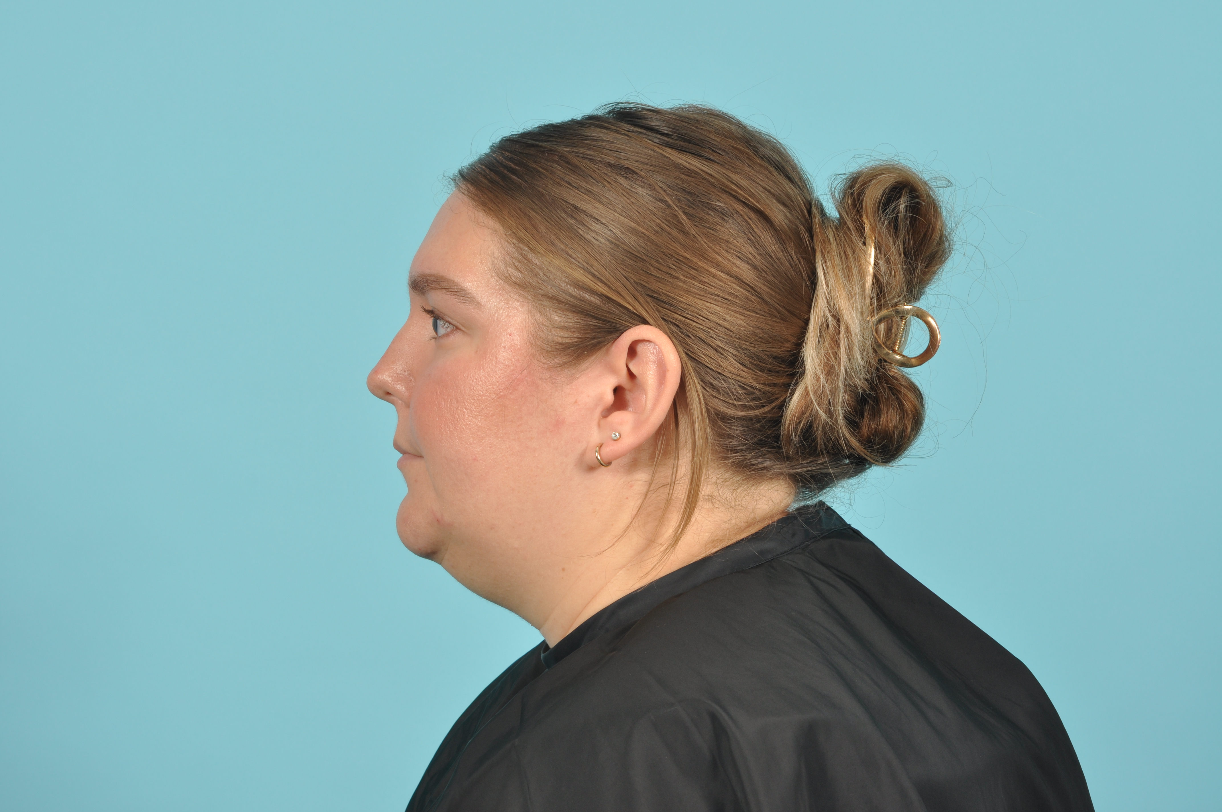 Liposuction Before & After Image