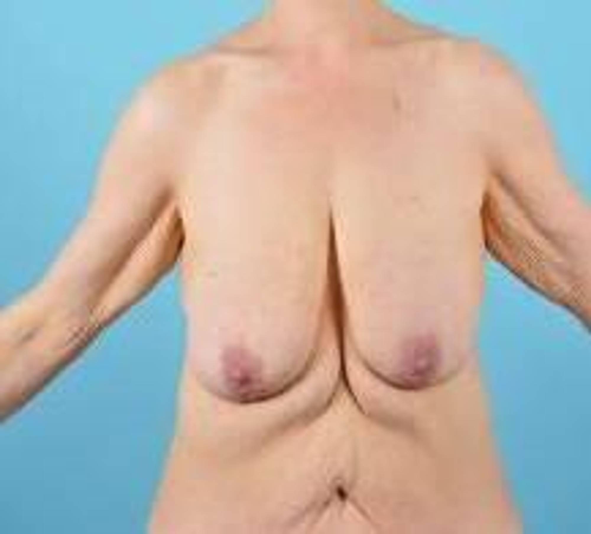 Mommy makeover Before & After Image