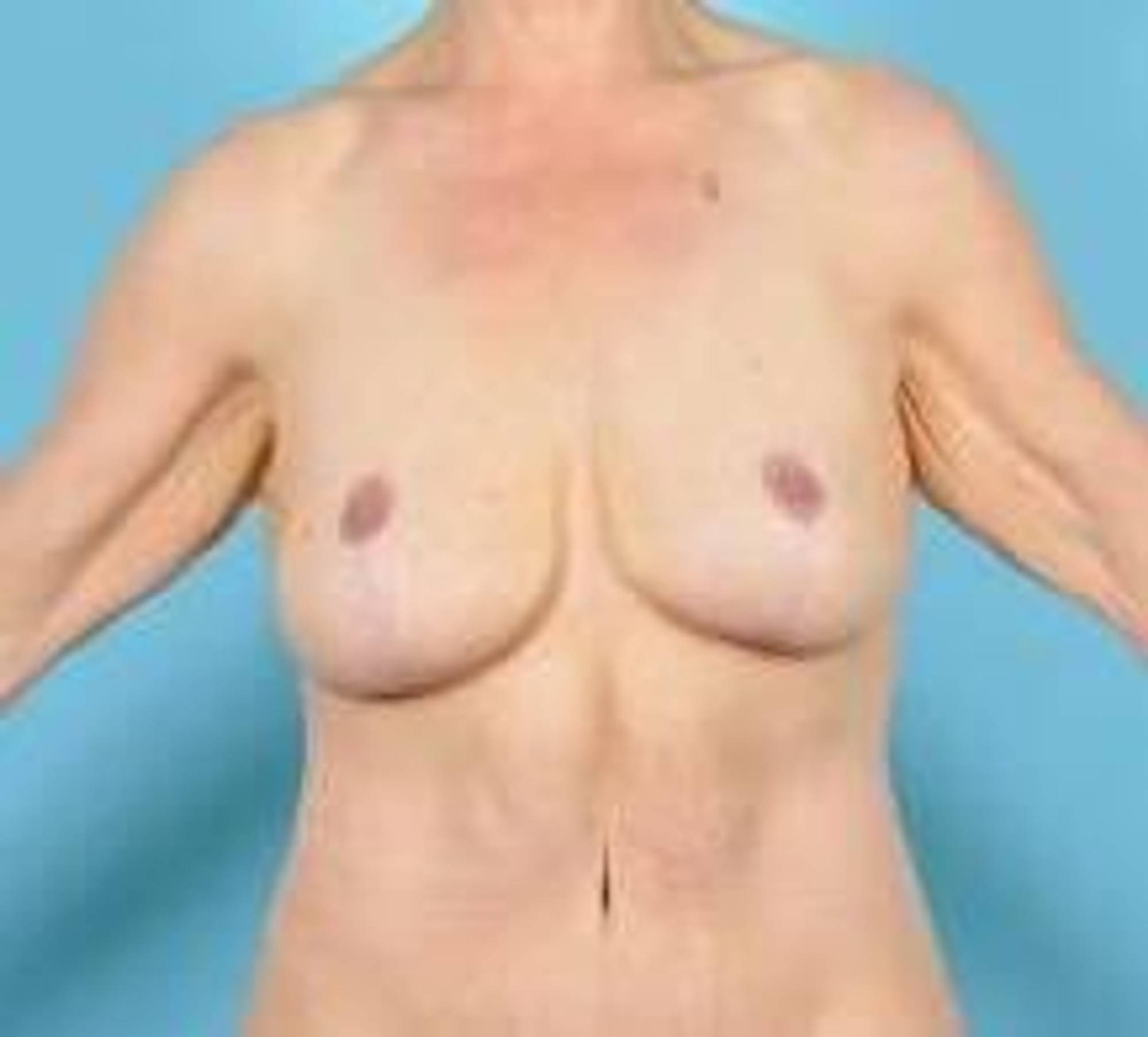 Mommy makeover Before & After Image