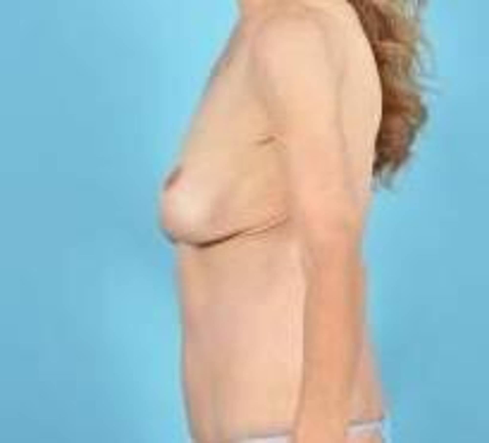 Mommy makeover Before & After Image