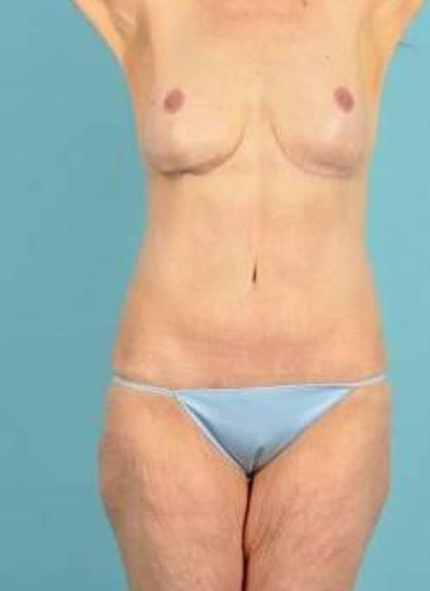  Before & After Image