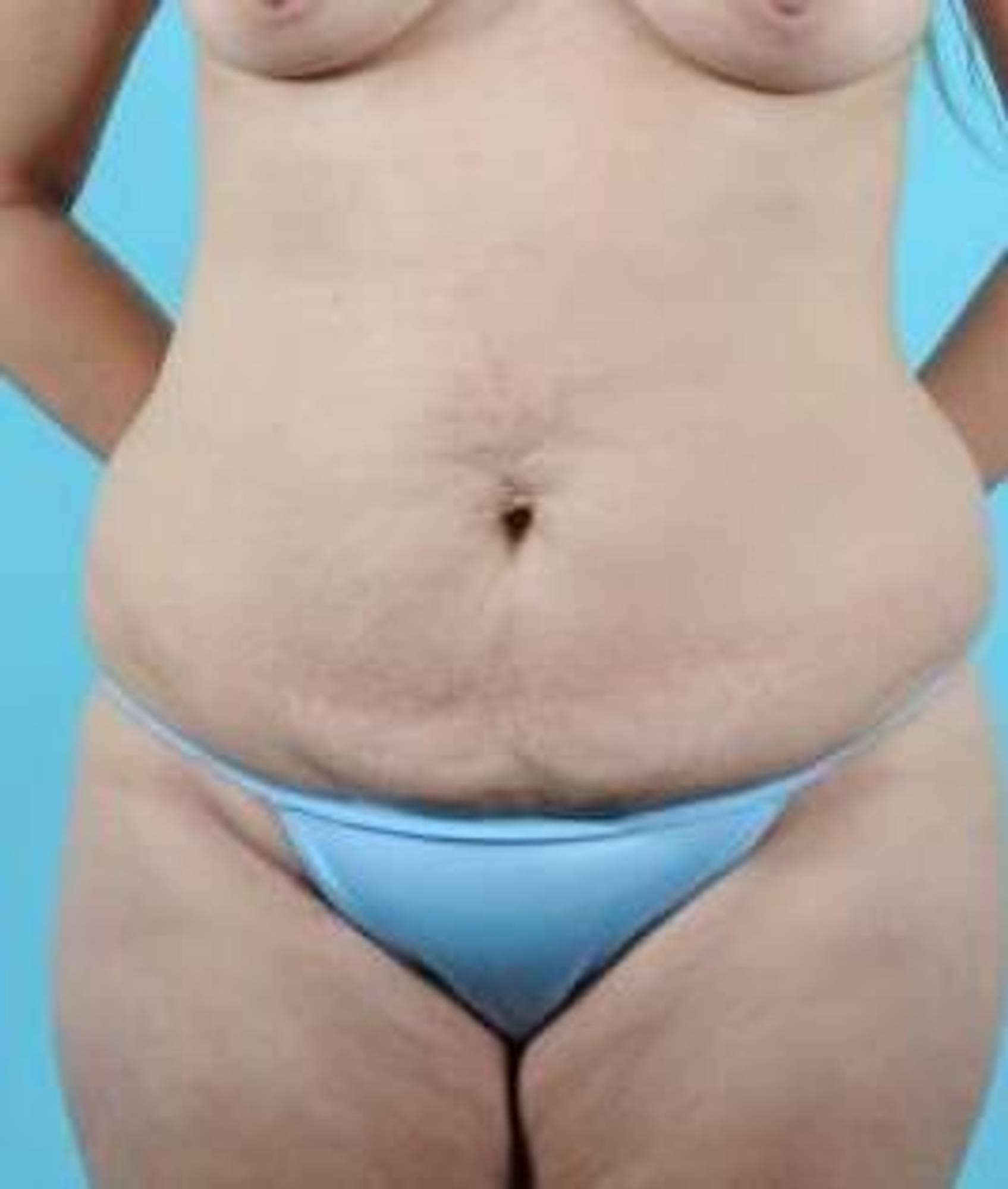 Mommy makeover Before & After Image