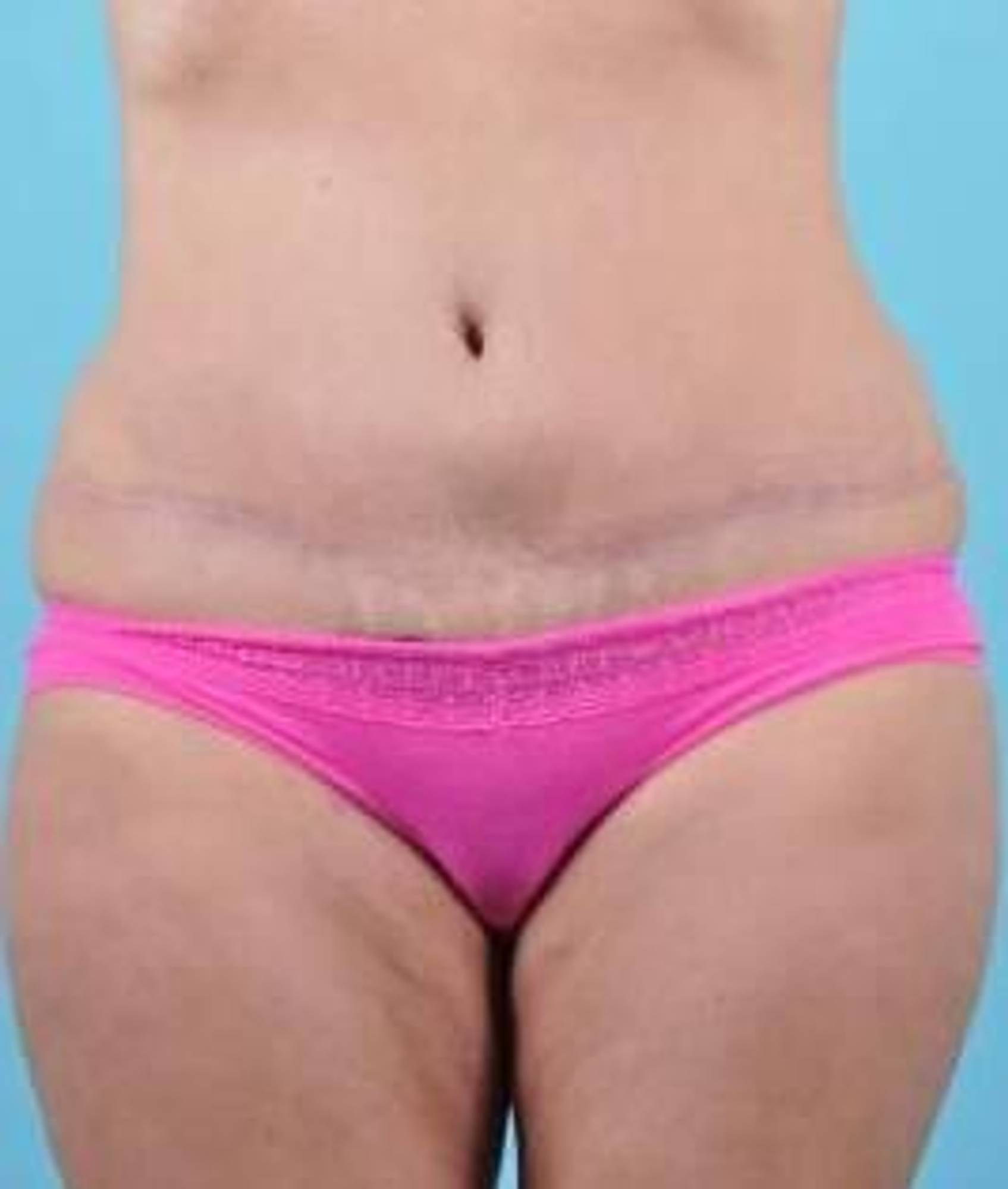 Mommy makeover Before & After Image