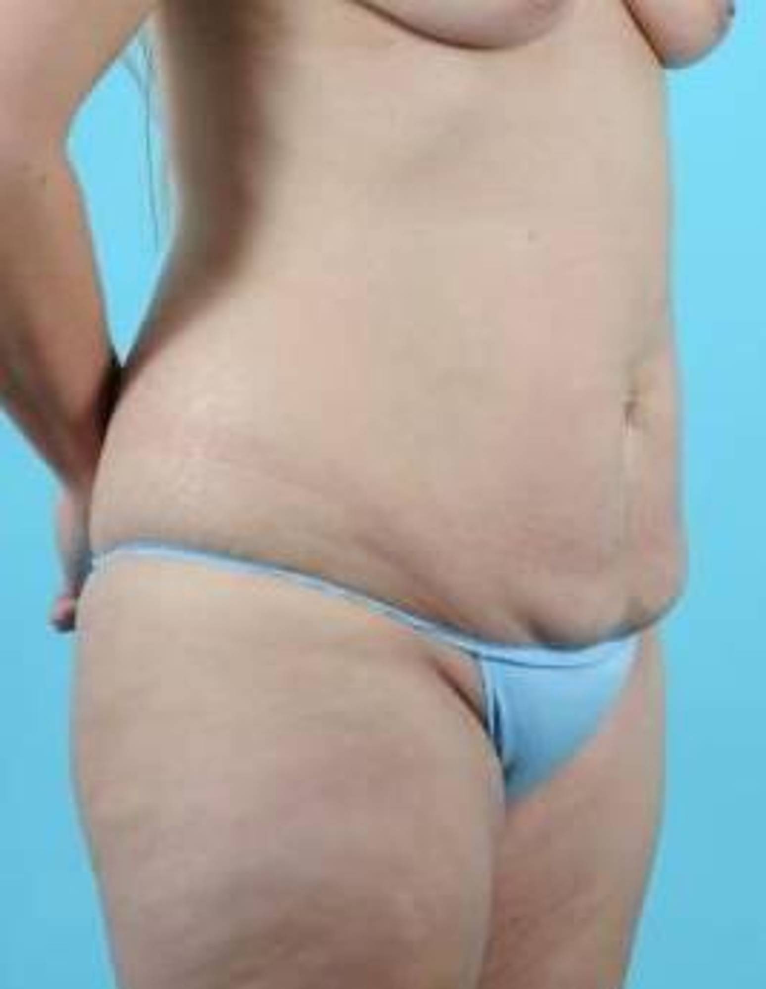 Mommy makeover Before & After Image