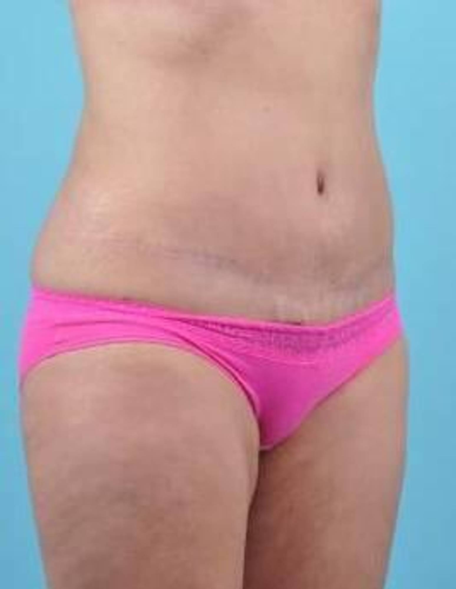 Mommy makeover Before & After Image