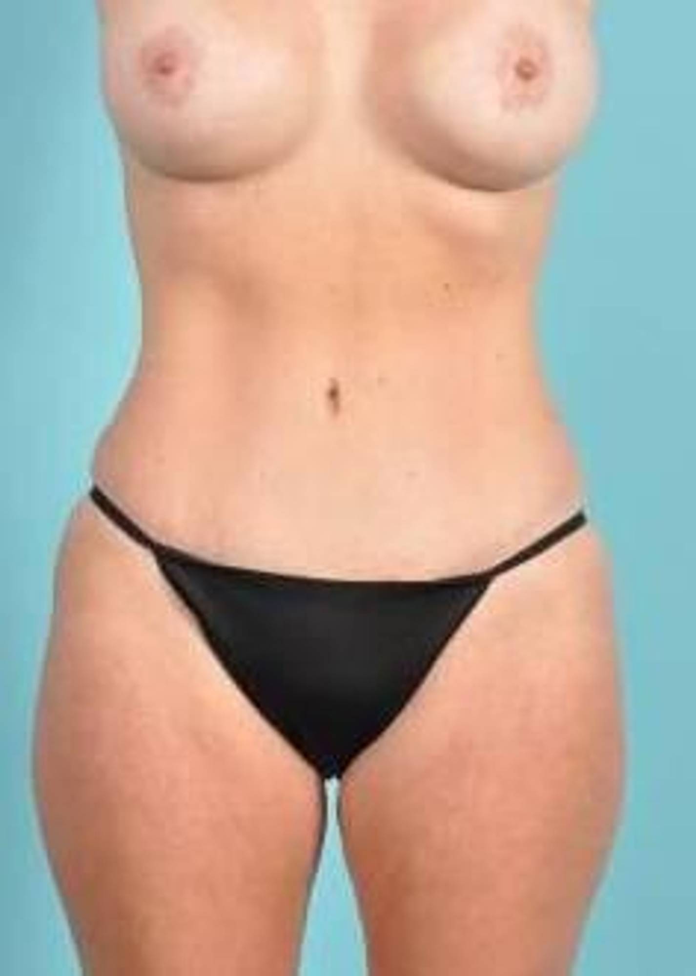  Before & After Image