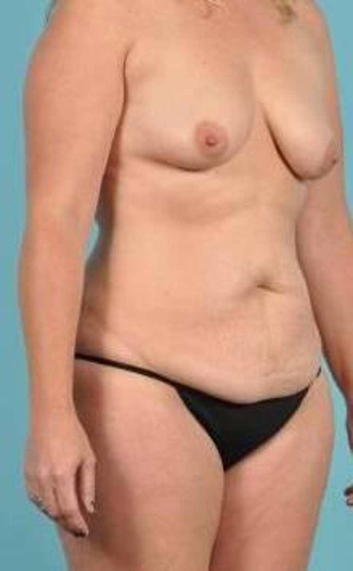  Before & After Image