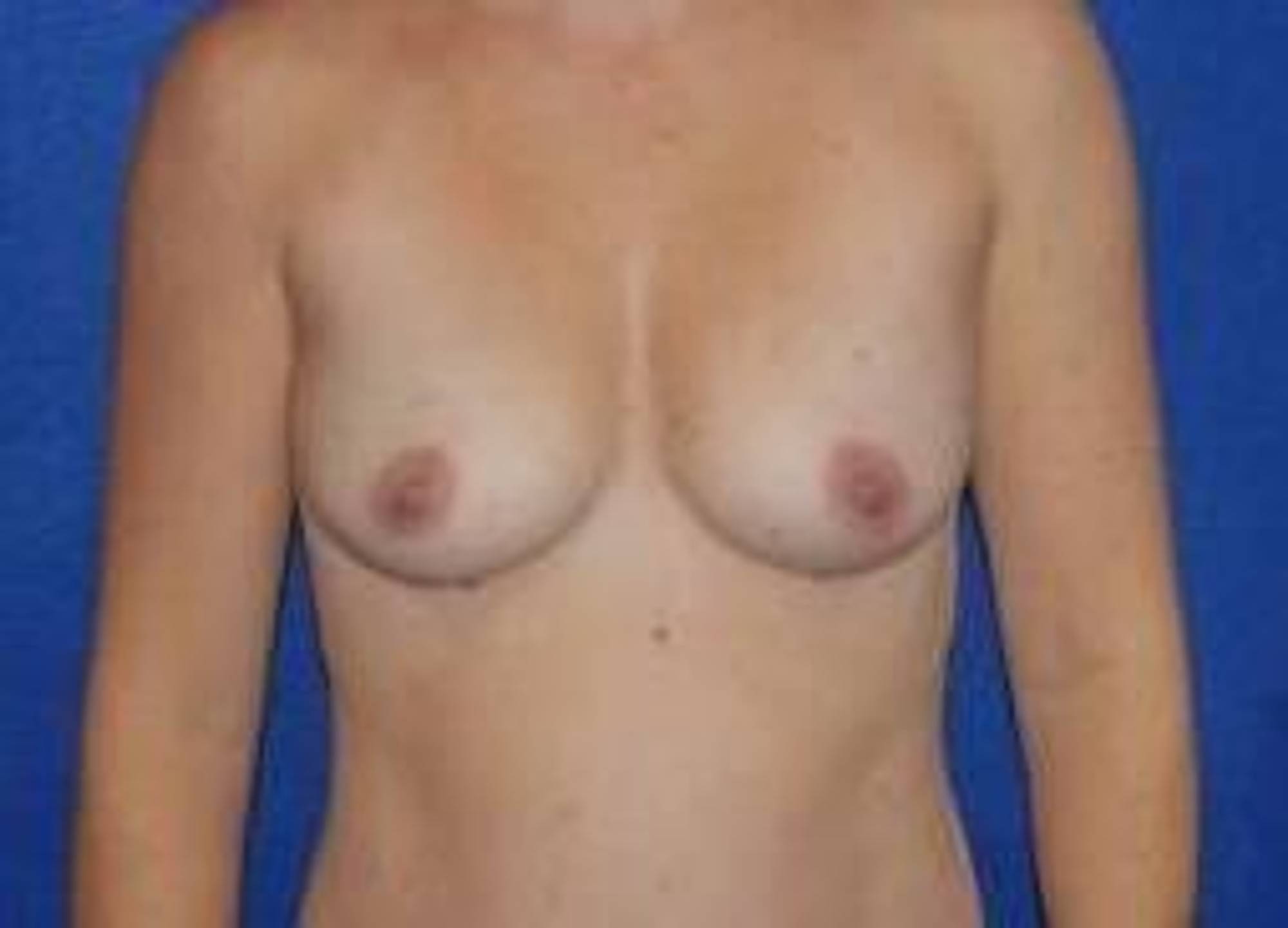  Before & After Image