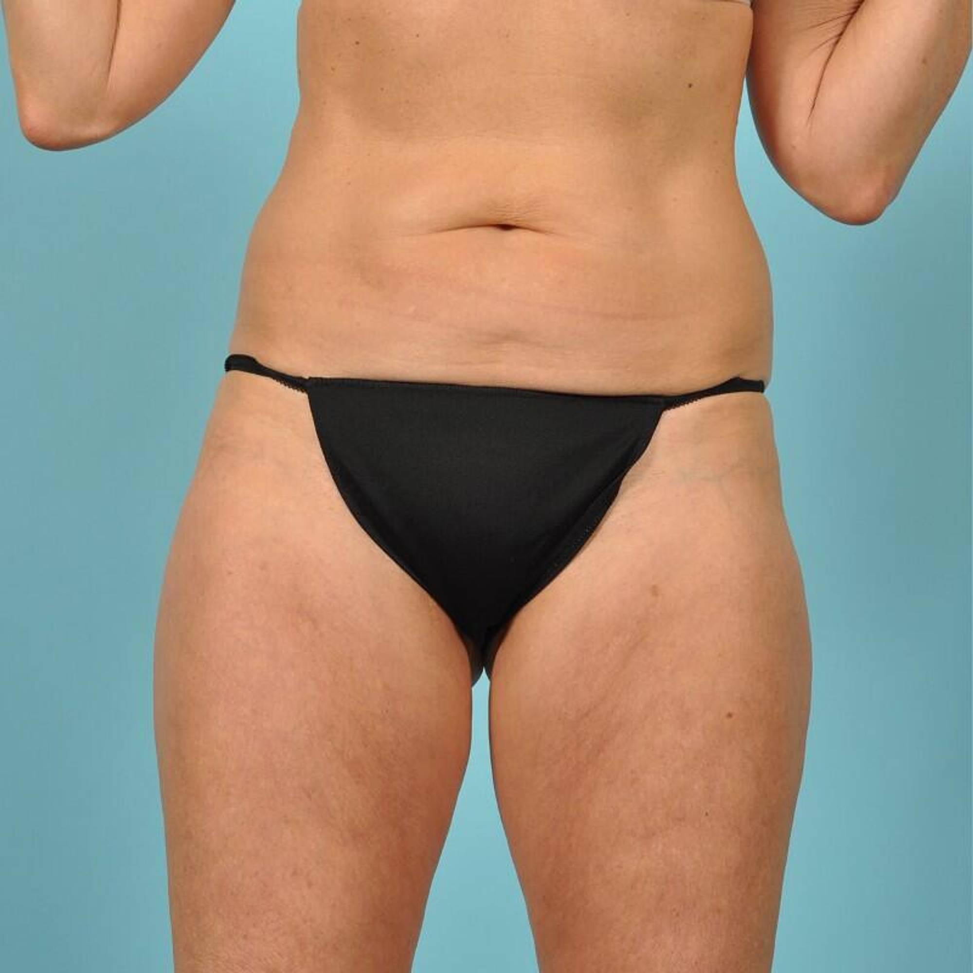 Thigh Lift Before & After Image